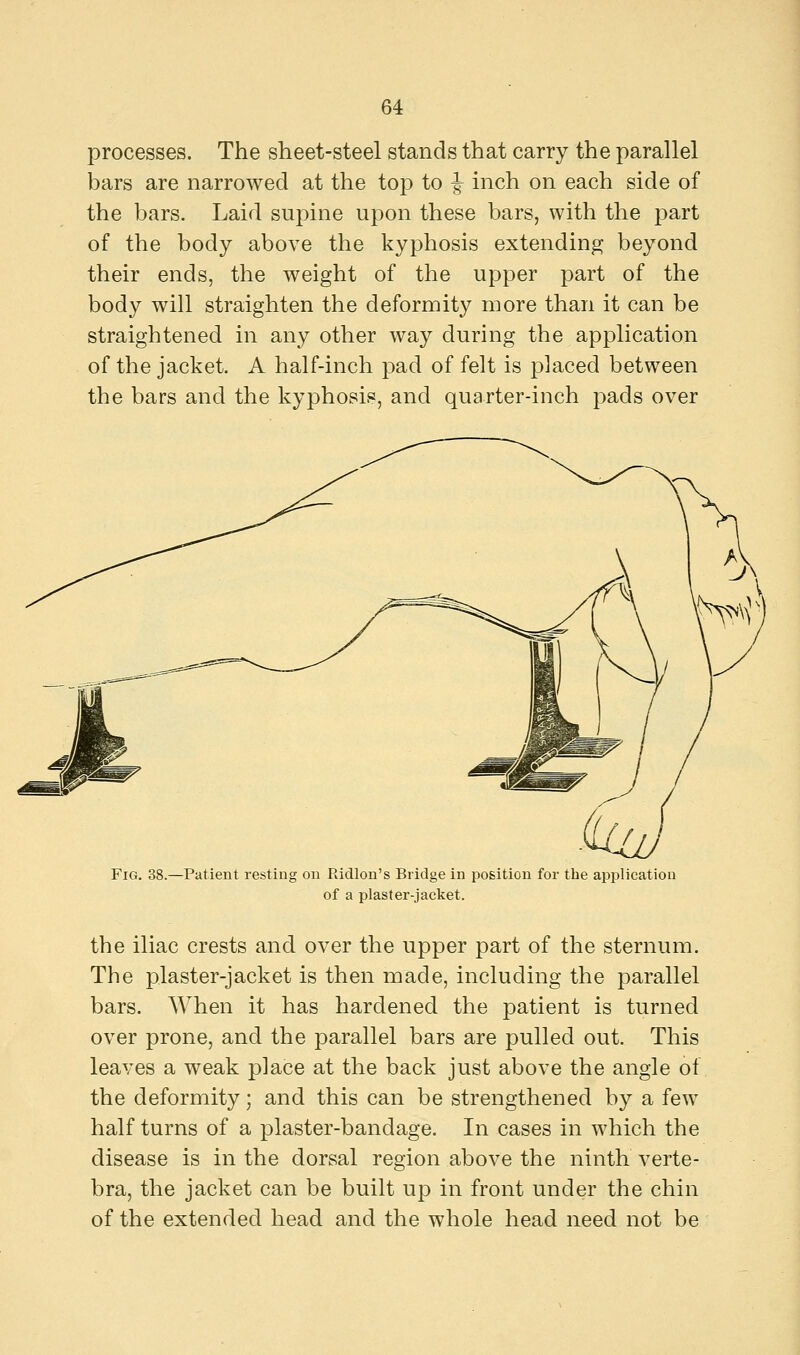 processes. The sheet-steel stands that carry the parallel bars are narrowed at the top to -| inch on each side of the bars. Laid supine upon these bars, with the part of the body above the kyphosis extending beyond their ends, the weight of the upper part of the body will straighten the deformity more than it can be straightened in any other way during the application of the jacket. A half-inch pad of felt is placed between the bars and the kyphosis, and quarter-inch pads over Fig. 38.—Patient resting on Pddlon's Bridge in position for the application of a plaster-jacket. the iliac crests and over the upper part of the sternum. The plaster-jacket is then made, including the parallel bars. When it has hardened the patient is turned over prone, and the parallel bars are pulled out. This leaves a weak place at the back just above the angle of the deformity; and this can be strengthened by a few half turns of a plaster-bandage. In cases in which the disease is in the dorsal region above the ninth verte- bra, the jacket can be built up in front under the chin of the extended head and the whole head need not be