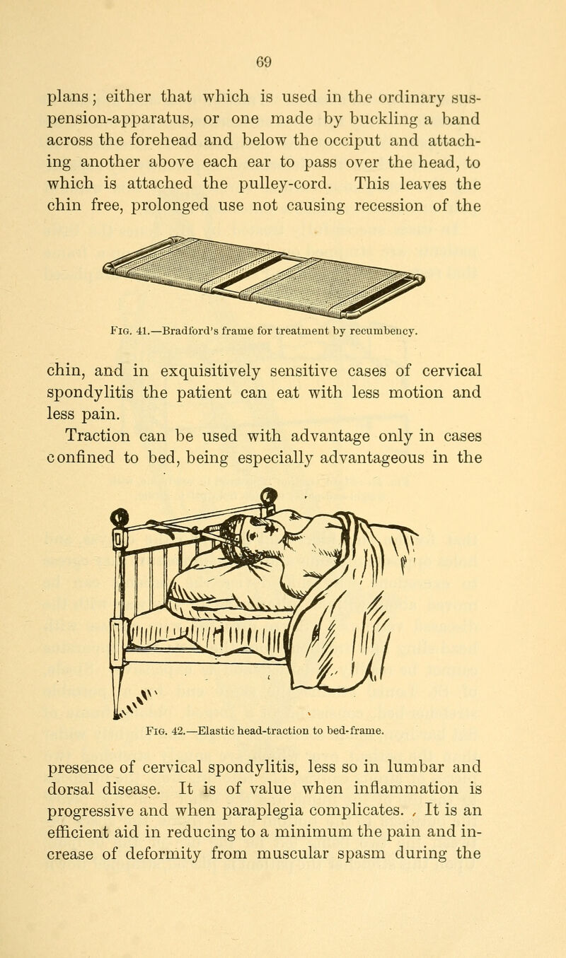 plans; either that which is used in the ordinary sus- pension-apparatus, or one made by buckling a band across the forehead and below the occiput and attach- ing another above each ear to pass over the head, to which is attached the pulley-cord. This leaves the chin free, prolonged use not causing recession of the Fig. 41.—Bradford's frame for treatment by recumbency. chin, and in exquisitively sensitive cases of cervical spondylitis the patient can eat with less motion and less pain. Traction can be used with advantage only in cases confined to bed, being especially advantageous in the Fig. 42.—Elastic head-traction to bed-frame. presence of cervical spondylitis, less so in lumbar and dorsal disease. It is of value when inflammation is progressive and when paraplegia complicates. , It is an efficient aid in reducing to a minimum the pain and in- crease of deformity from muscular spasm during the