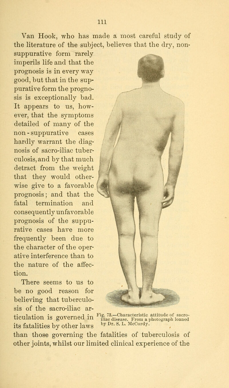 Van Hook, who has made a most careful study of the literature of the subject, believes that the dry, non- suppurative form rarely imperils life and that the prognosis is in every way good, but that in the sup- purative form the progno- sis is exceptionally bad. It appears to us, how- ever, that the symptoms detailed of many of the non - suppurative cases hardly warrant the diag- nosis of sacro-iliac tuber- culosis, and by that much detract from the weight that they would other- wise give to a favorable prognosis; and that the fatal termination and consequently unfavorable prognosis of the suppu- rative cases have more frequently been due to the character of the oper- ative interference than to the nature of the affec- tion. There seems to us to be no good reason for believing that tuberculo- sis of the sacro-iliac ar- ticulation is governed in its fatalities by other laws than those governing the fatalities of tuberculosis of other joints, whilst our limited clinical experience of the Fig. 73.—Characteristic attitude of sacro- iliac disease. From a photograph loaned by Dr. S. L. McCurdy.