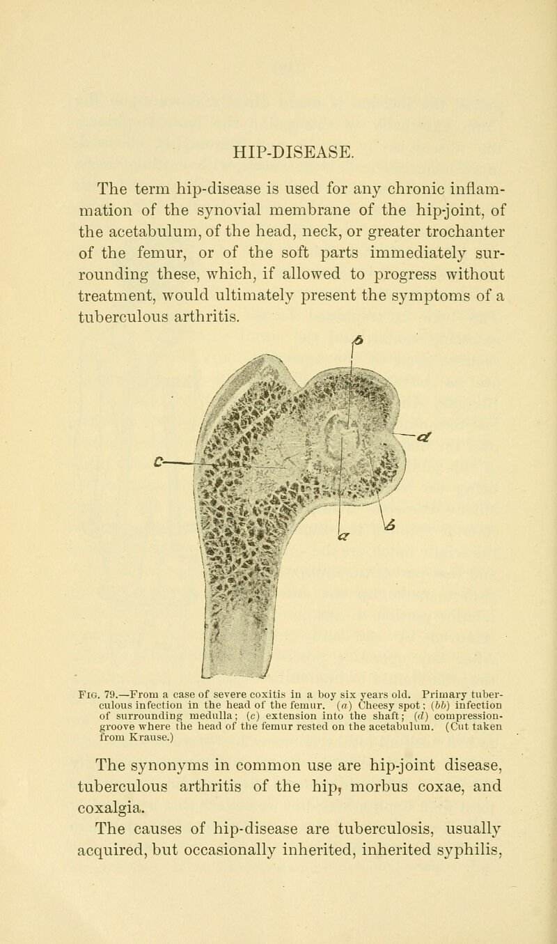 HIP-DISEASE. The term hip-disease is used for any chronic inflam- mation of the synovial membrane of the hip-joint, of the acetabulum, of the head, neck, or greater trochanter of the femur, or of the soft parts immediately sur- rounding these, which; if allowed to progress without treatment, would ultimately present the symptoms of a tuberculous arthritis. —a \ a l> ■ J Fig. 79.—From a case of severe coxitis in a boy six years old. Primary tuber- culous infection in the head of the femur, (a) Cheesy spot; (bb) infection of surrounding medulla; (c) extension into the shaft; (d) compression- groove where the head of the femur rested on the acetabulum. (Cut taken from Krause.) The synonyms in common use are hip-joint disease, tuberculous arthritis of the hip, morbus coxae, and coxalgia. The causes of hip-disease are tuberculosis, usually acquired, but occasionally inherited, inherited syphilis,