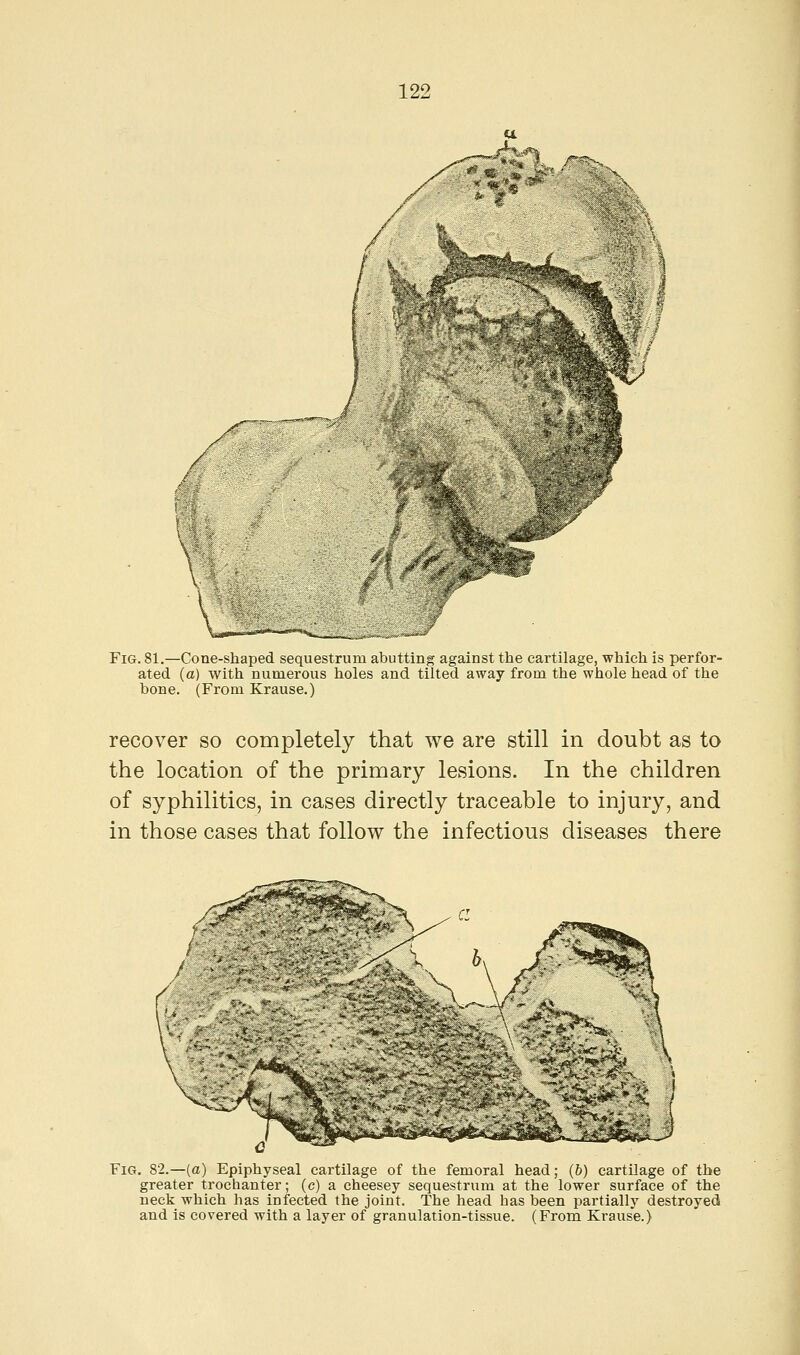 / •' '<, Fig. 81.—Cone-shaped sequestrum abutting against the cartilage, which is perfor- ated (a) with numerous holes and tilted away from the whole head of the bone. (From Krause.) recover so completely that we are still in doubt as to the location of the primary lesions. In the children of syphilitics, in cases directly traceable to injury, and in those cases that follow the infectious diseases there Fig. 82.—(a) Epiphyseal cartilage of the femoral head; (6) cartilage of the greater trochanter; (c) a cheesey sequestrum at the lower surface of the neck which has infected the joint. The head has been partially destroyed and is covered with a layer of granulation-tissue. (From Krause.)