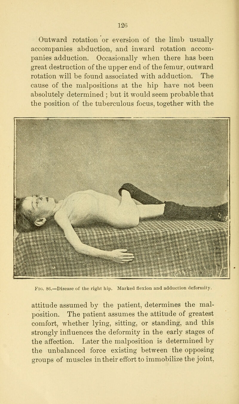 Outward rotation or eversion of the limb usually accompanies abduction, and inward rotation accom- panies adduction. Occasionally when there has been great destruction of the upper end of the femur, outward rotation will be found associated with adduction. The cause of the malpositions at the hip have not been absolutely determined ; but it would seem probable that the position of the tuberculous focus, together with the Fig. 86.—Disease of the right hip. Marked flexion and adduction deformity. attitude assumed by the patient, determines the mal- position. The patient assumes the attitude of greatest comfort, whether lying, sitting, or standing, and this strongly influences the deformity in the early stages of the affection. Later the malposition is determined by the unbalanced force existing between the opposing groups of muscles in their effort to immobilize the joint,