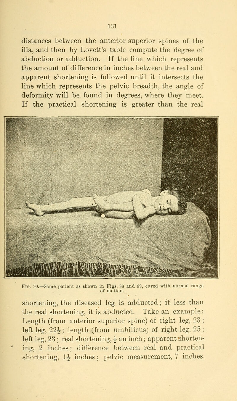 distances between the anterior superior spines of the ilia, and then by Lovett's table compute the degree of abduction or adduction. If the line which represents the amount of difference in inches between the real and apparent shortening is followed until it intersects the line which represents the pelvic breadth, the angle of deformity will be found in degrees, where they meet. If the practical shortening is greater than the real Fig. 90.—Same patient as shown in Figs. 88 and 89, cured with normal range of motion. shortening, the diseased leg is adducted; it less than the real shortening, it is abducted. Take an example: Length (from anterior superior spine) of right leg, 23; left leg, 22J; length (from umbilicus) of right leg, 25; left leg, 23 ; real shortening, § an inch; apparent shorten- ing, 2 inches; difference between real and practical shortening, \\ inches ; pelvic measurement, 7 inches.