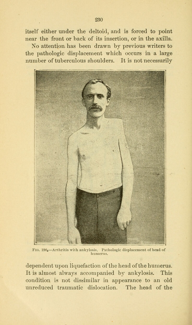 itself either under the deltoid, and is forced to point near the front or back of its insertion, or in the axilla. No attention, has been drawn by previous writers to the pathologic displacement which occurs in a large number of tuberculous shoulders. It is not necessarily Fig. 190,—Arthritis with ankylosis. Pathologic displacement of head of humerus. dependent upon liquefaction of the head of the humerus. It is almost always accompanied by ankylosis. This condition is not dissimilar in appearance to an old unreduced traumatic dislocation. The head of the