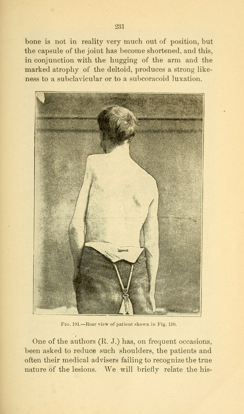 bone is not in reality very much out of position, but the capsule of the joint has become shortened, and this, in conjunction with the hugging of the arm and the marked atrophy of the deltoid, produces a strong like- ness to a subclavicular or to a subcoracoid luxation. Fig. 191.—Rear view of patient shown in Fig. 190. One of the authors (R. J.) has, on frequent occasions, been asked to reduce such shoulders, the patients and often their medical advisers failing to recognize the true nature of the lesions. We will brienv relate the his-