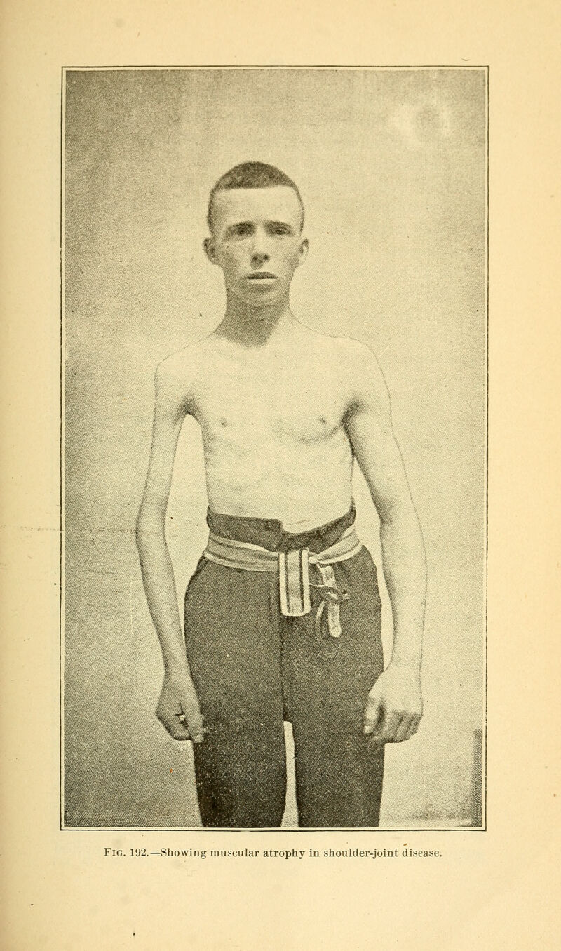 Fig. 192.—Showing muscular atrophy in shoulder-joint disease.