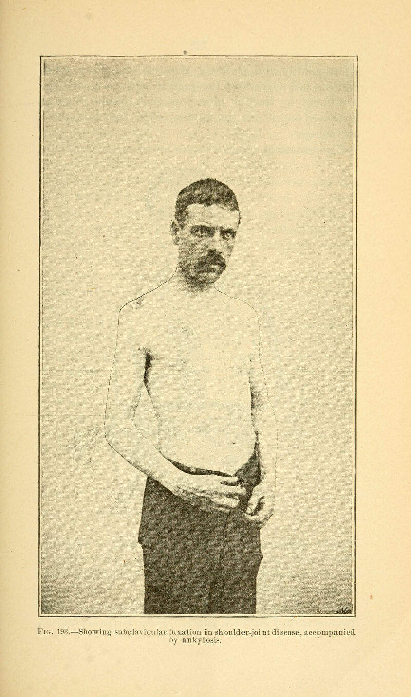 Fig. 193.—Showing subclavicular luxation in shoulder-joint disease, accompanied by ankylosis.