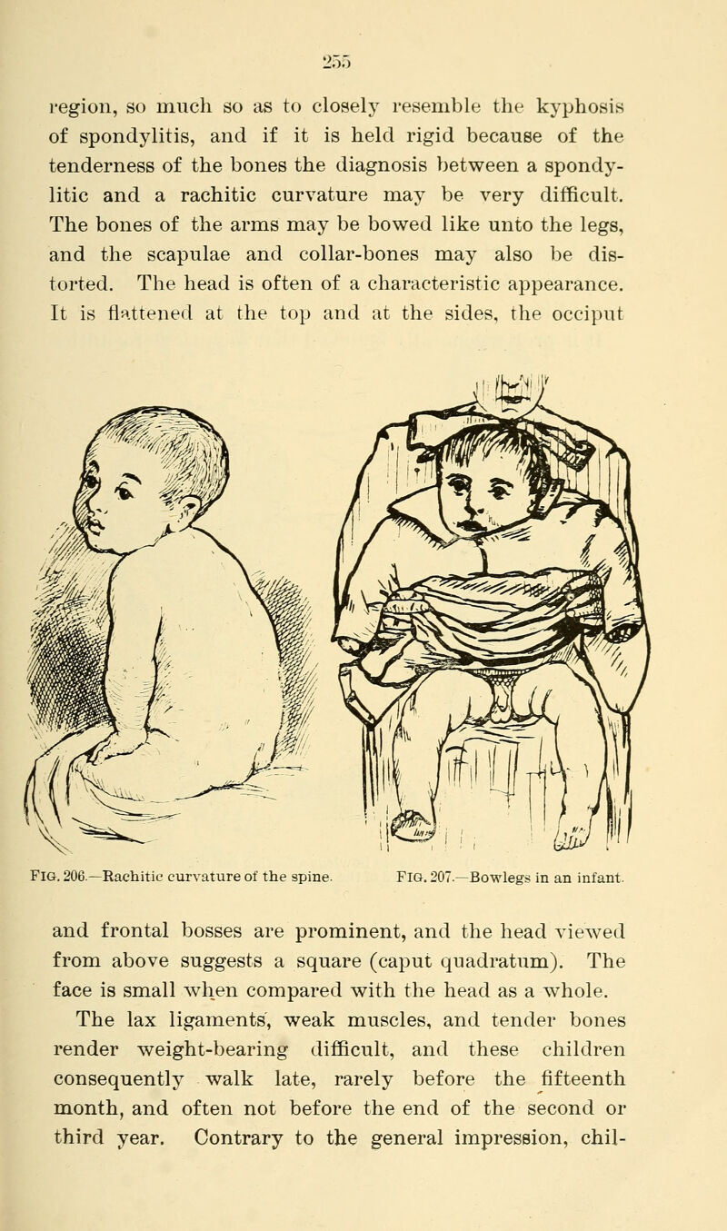 region, so much so as to closely resemble the kyphosis of spondylitis, and if it is held rigid because of the tenderness of the bones the diagnosis between a spondy- litic and a rachitic curvature may be very difficult. The bones of the arms may be bowed like unto the legs, and the scapulae and collar-bones may also be dis- torted. The head is often of a characteristic appearance. It is flattened at the top and at the sides, the occiput Fig. 206.—Rachitic curvature of the spine. FIG. 207.—Bowlegs in an infant. and frontal bosses are prominent, and the head viewed from above suggests a square (caput quadratum). The face is small when compared with the head as a whole. The lax ligaments, weak muscles, and tender bones render weight-bearing difficult, and these children consequently walk late, rarely before the fifteenth month, and often not before the end of the second or third year. Contrary to the general impression, chil-