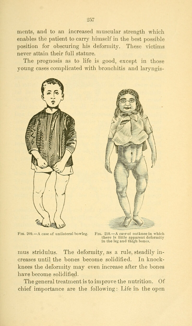 ments, and to an increased muscular strength which enables the patient to carry himself in the best possible position for obscuring his deformity. These victims never attain their full stature. The prognosis as to life is good, except in those young cases complicated with bronchitis and laryngis- Fig. 209.—A case of unilateral bowleg. Fig. 210.—A case of outkneein which there is little apparent deformity in the leg and thigh bones. mus stridulus. The deformity, as a rule, steadily in- creases until the bones become solidified. In knock- knees the deformity may even increase after the bones have become solidified. The general treatment is to improve the nutrition. Of chief importance are the following: Life in the open