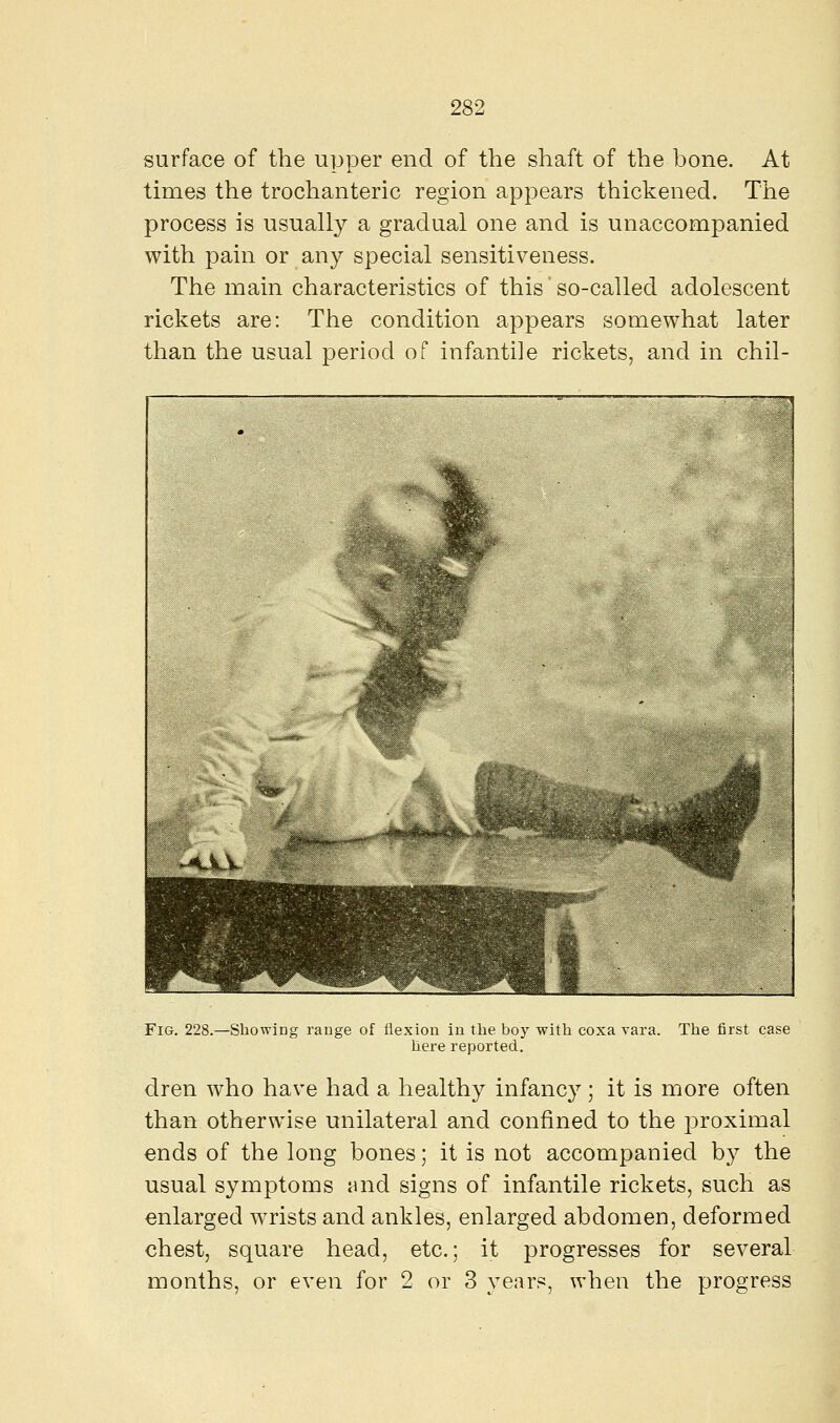 surface of the upper end of the shaft of the bone. At times the trochanteric region appears thickened. The process is usually a gradual one and is unaccompanied with pain or any special sensitiveness. The main characteristics of this' so-called adolescent rickets are: The condition appears somewhat later than the usual period of infantile rickets, and in chil- '*^V*Jk- Fig. 228.—Showing range of flexion in the boy with coxa vara. The first case here reported. dren who have had a healthy infancy ; it is more often than otherwise unilateral and confined to the proximal ends of the long bones; it is not accompanied by the usual symptoms and signs of infantile rickets, such as enlarged wrists and ankles, enlarged abdomen, deformed chest, square head, etc.; it progresses for several months, or even for 2 or 3 years, when the progress