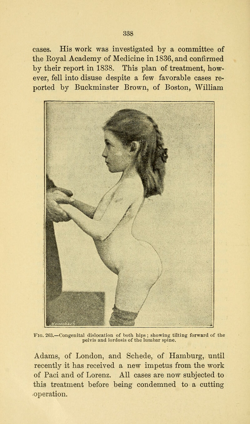 cases. His work was investigated by a committee of the Royal Academy of Medicine in 1836, and confirmed by their report in 1838. This plan of treatment, how- ever, fell into disuse despite a few favorable cases re- ported by Buckminster Brown, of Boston, William Fig. 263.—Congenital dislocation of both hips; showing tilting forward of the pelvis and lordosis of the lumbar spine. Adams, of London, and Schede, of Hamburg, until recently it has received a new impetus from the work of Paci and of Lorenz. All cases are now subjected to this treatment before being condemned to a cutting operation.