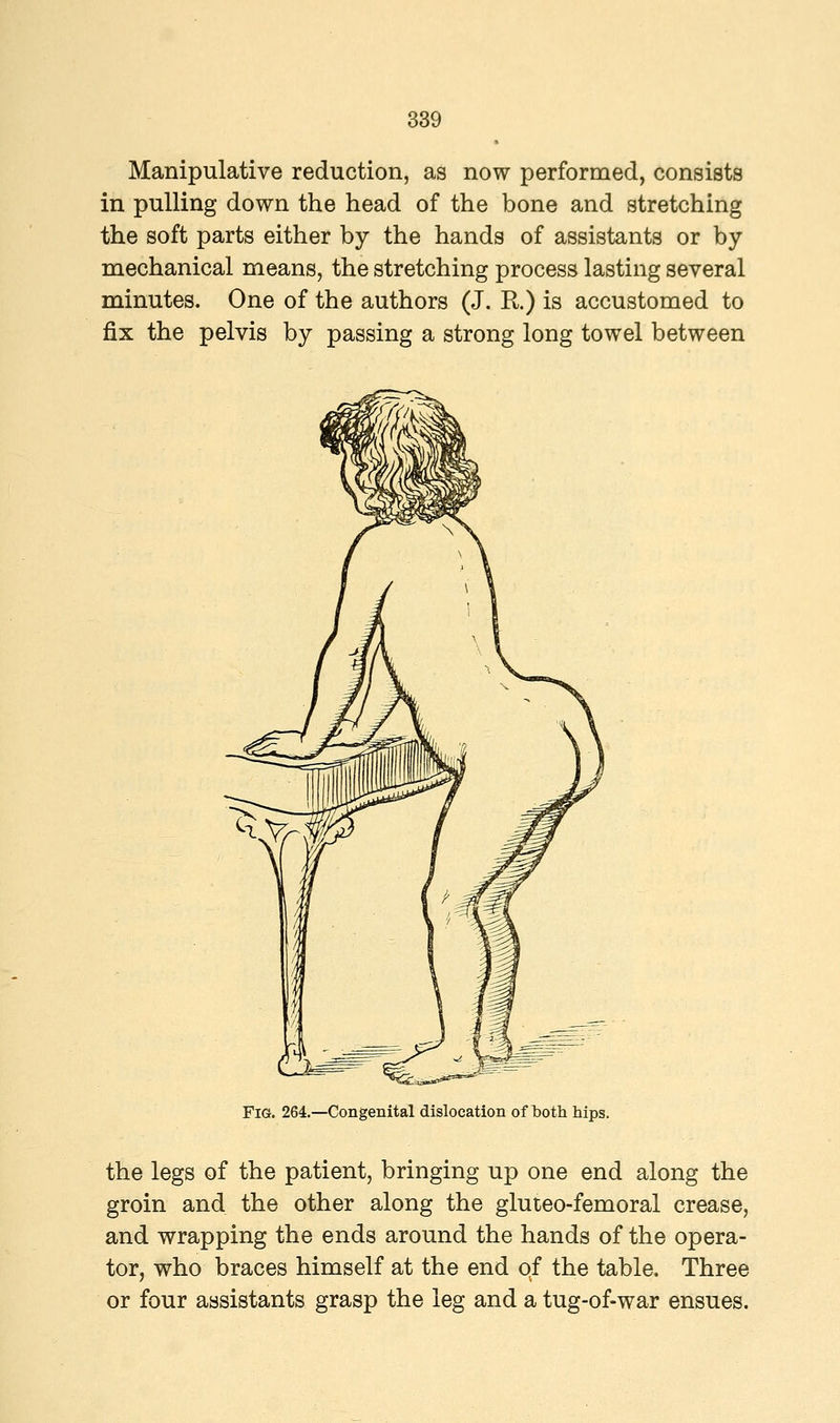 Manipulative reduction, as now performed, consists in pulling down the head of the bone and stretching the soft parts either by the hands of assistants or by mechanical means, the stretching process lasting several minutes. One of the authors (J. R.) is accustomed to fix the pelvis by passing a strong long towel between Fig. 264.—Congenital dislocation of both hips. the legs of the patient, bringing up one end along the groin and the other along the gluteo-femoral crease, and wrapping the ends around the hands of the opera- tor, who braces himself at the end of the table. Three or four assistants grasp the leg and a tug-of-war ensues.