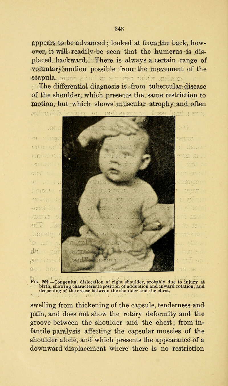 appears tebeiadvariced ; looked at fromHhe back, how- ev^Mit T^Lba-eadilybe seen that the Jbumerusris dis- placed backward;! There is always a certain ; range of ^yoluntar^motion possible from the mo-yement of the scapula, y m . ,: ' j / .:' ;c The differentia! diagnosis is -from tubercular disease of the shoulder, which presents the same restriction to motion, but .which shows mfisculaT atrophy and often M Fig. 269.—Congenital dislocation of right shoulder, probably due to injury at birth, showing characteristic position of adduction and inward rotation, and deepening of the crease between the sboulder and the chest. swelling from thickening of the capsule, tenderness and pain, and does not show the rotary deformity and the groove between the shoulder and the chest; from in- fantile paralysis affecting the capsular muscles of the shoulder alone, arid' which presents the appearance of a downward displacement where there is no restriction