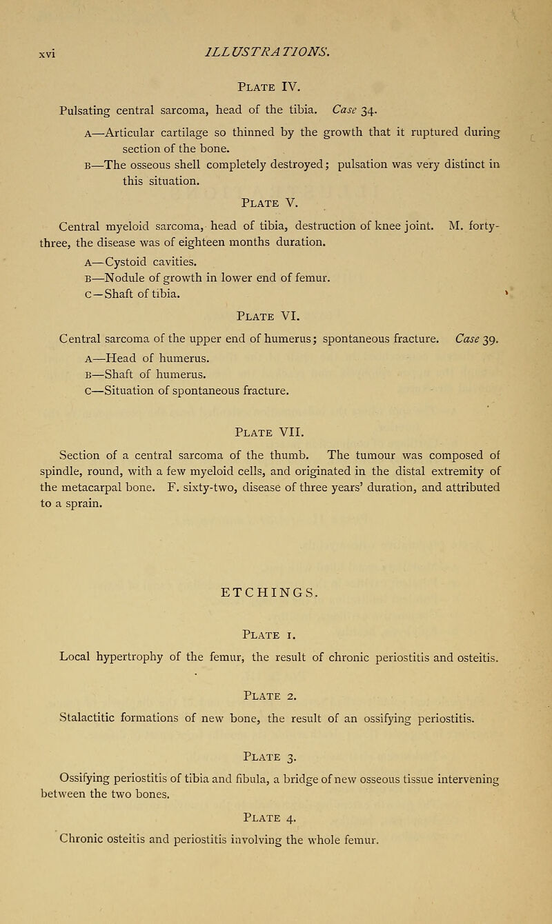 Plate IV. Pulsating central sarcoma, head of the tibia. Case 34. A—Articular cartilage so thinned by the growth that it ruptured during section of the bone. B—The osseous shell completely destroyed; pulsation was very distinct in this situation. Plate V. Central myeloid sarcoma, head of tibia, destruction of knee joint. M. forty- three, the disease was of eighteen months duration. A—Cystoid cavities. B—Nodule of growth in lower end of femur, c—Shaft of tibia. ' Plate VI. Central sarcoma of the upper end of humerus; spontaneous fracture. Case 39. a—Head of humerus. B—Shaft of humerus. c—Situation of spontaneous fracture. Plate VII. Section of a central sarcoma of the thumb. The tumour was composed of spindle, round, with a few myeloid cells, and originated in the distal extremity of the metacarpal bone. F. sixty-two, disease of three years' duration, and attributed to a sprain. ETCHINGS. Plate i. Local hypertrophy of the femur, the result of chronic periostitis and osteitis. Plate 2. Stalactitic formations of new bone, the result of an ossifying periostitis. Plate 3. Ossifying periostitis of tibia and fibula, a bridge of new osseous tissue intervening between the two bones. Plate 4, Chronic osteitis and periostitis involving the whole femur.