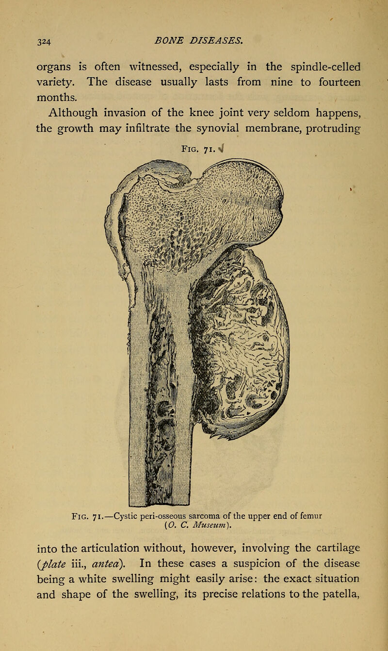 organs is often witnessed, especially in the spindle-celled variety. The disease usually lasts from nine to fourteen months. Although invasion of the knee joint very seldom happens, the growth may infiltrate the synovial membrane, protruding Fig. 71. W Fig. 71.—Cystic peri-osseous sarcoma of the upper end of femur (C, C. Museum). into the articulation without, however, involving the cartilage {plate iii., antea). In these cases a suspicion of the disease being a white swelling might easily arise: the exact situation and shape of the swelling, its precise relations to the patella,