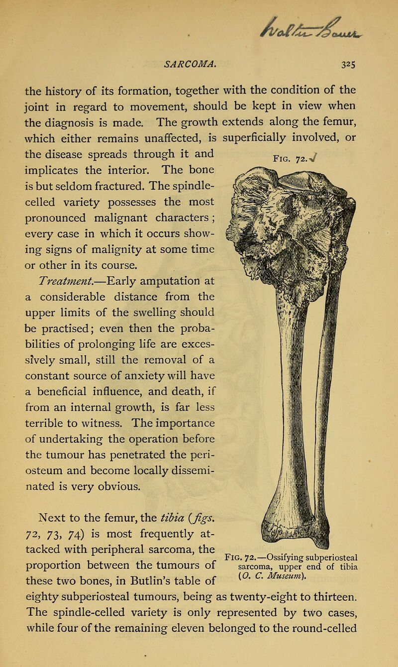 /i/tsf^^ir:oa< tUjMm- SARCOMA. 325 the history of its formation, together with the condition of the joint in regard to movement, should be kept in view when the diagnosis is made. The growth extends along the femur, which either remains unaffected, is superficially involved, or Fig. 72. V the disease spreads through it and implicates the interior. The bone is but seldom fractured. The spindle- celled variety possesses the most pronounced malignant characters; every case in which it occurs show- ing signs of malignity at some time or other in its course. Treatment.—Early amputation at a considerable distance from the upper limits of the swelling should be practised; even then the proba- bilities of prolonging life are exces- sively small, still the removal of a constant source of anxiety will have a beneficial influence, and death, if from an internal growth, is far less terrible to witness. The importance of undertaking the operation before the tumour has penetrated the peri- osteum and become locally dissemi- nated is very obvious. Next to the femur, the tibia {figs. 72, 73, 74) is most frequently at- tacked with peripheral sarcoma, the proportion between the tumours of these two bones, in Butlin's table of eighty subperiosteal tumours, being as twenty-eight to thirteen. The spindle-celled variety is only represented by two cases, while four of the remaining eleven belonged to the round-celled Fig. 72.—Ossifying subperiosteal sarcoma, upper end of tibia {0. C. Museutn).