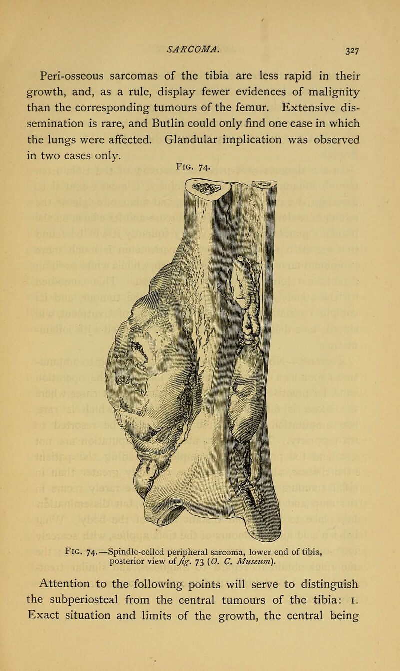 Peri-osseous sarcomas of the tibia are less rapid in their growth, and, as a rule, display fewer evidences of malignity than the corresponding tumours of the femur. Extensive dis- semination is rare, and Butlin could only find one case in which the lungs were affected. Glandular implication was observed in two cases only. Fig. 74. Fig. 74.—Spindle-celled peripheral sarcoma, lower end of tibia, posterior view oifig. 73 (0. C. Museum). Attention to the following points will serve to distinguish the subperiosteal from the central tumours of the tibia: i. Exact situation and limits of the growth, the central being