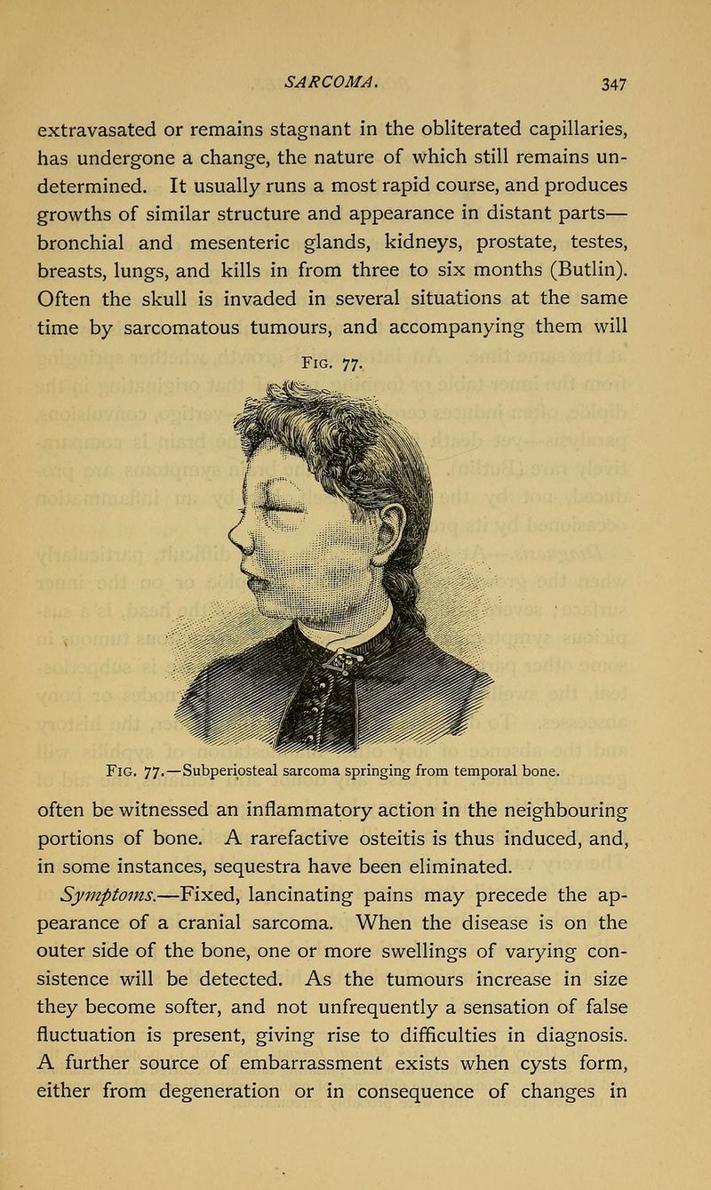 extravasated or remains stagnant in the obliterated capillaries, has undergone a change, the nature of which still remains un- determined. It usually runs a most rapid course, and produces growths of similar structure and appearance in distant parts— bronchial and mesenteric glands, kidneys, prostate, testes, breasts, lungs, and kills in from three to six months (Butlin). Often the skull is invaded in several situations at the same time by sarcomatous tumours, and accompanying them will Fig, 77.—Subperiosteal sarcoma springing from temporal bone often be witnessed an inflammatory action in the neighbouring portions of bone. A rarefactive osteitis is thus induced, and, in some instances, sequestra have been eliminated. Symptoms.—Fixed, lancinating pains may precede the ap- pearance of a cranial sarcoma. When the disease is on the outer side of the bone, one or more swellings of varying con- sistence will be detected. As the tumours increase in size they become softer, and not unfrequently a sensation of false fluctuation is present, giving rise to difficulties in diagnosis. A further source of embarrassment exists when cysts form, either from degeneration or in consequence of changes in