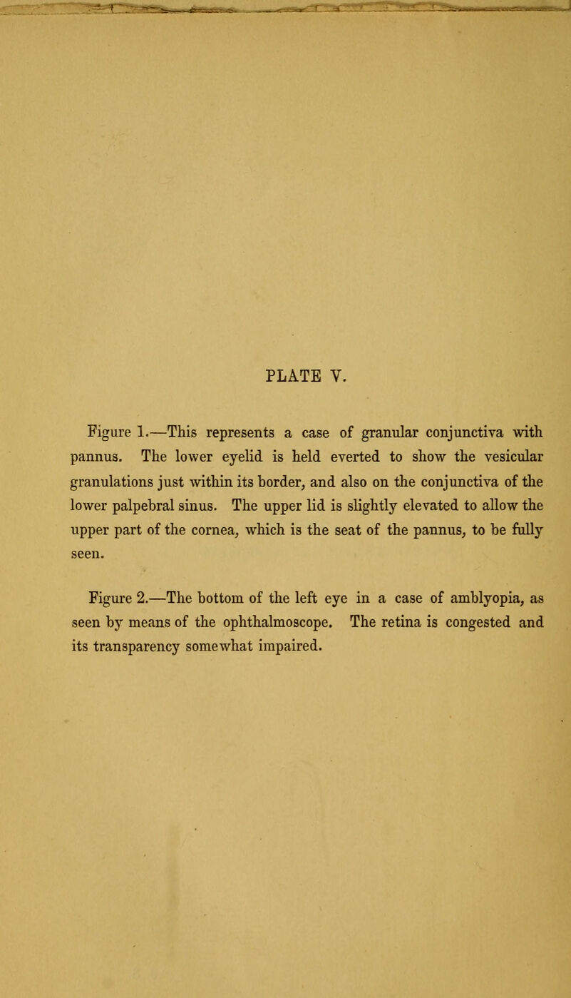 Figure 1.—This represents a case of granular conjunctiva with pannus. The lower eyelid is held everted to show the vesicular granulations just within its border, and also on the conjunctiva of the lower palpebral sinus. The upper lid is slightly elevated to allow the upper part of the cornea, which is the seat of the pannus, to be fully seen. Figure 2.—The bottom of the left eye in a case of amblyopia, as seen by means of the ophthalmoscope. The retina is congested and its transparency somewhat impaired.