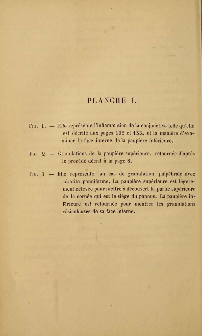 Fif,. 1. — Elle représente l'inflammation de la conjonctive telle qu'elle est décrite aux pages 102 et 153, et la manière d'exa- miner la face interne de la paupière inférieure. Fia. 2. — Granulations de la paupière supérieure, retournée d'après le procédé décrit à la page 8. Fif,. 3. — Elle représente un cas de granulation palpébrale avec kératite panniforme. La paupière supérieure est légère- ment relevée pour mettre à découvert la partie supérieure de la cornée qui est le siège du pannus. La paupière in- férieure est retournée pour montrer les granulations vésiculeuses de sa face interne.