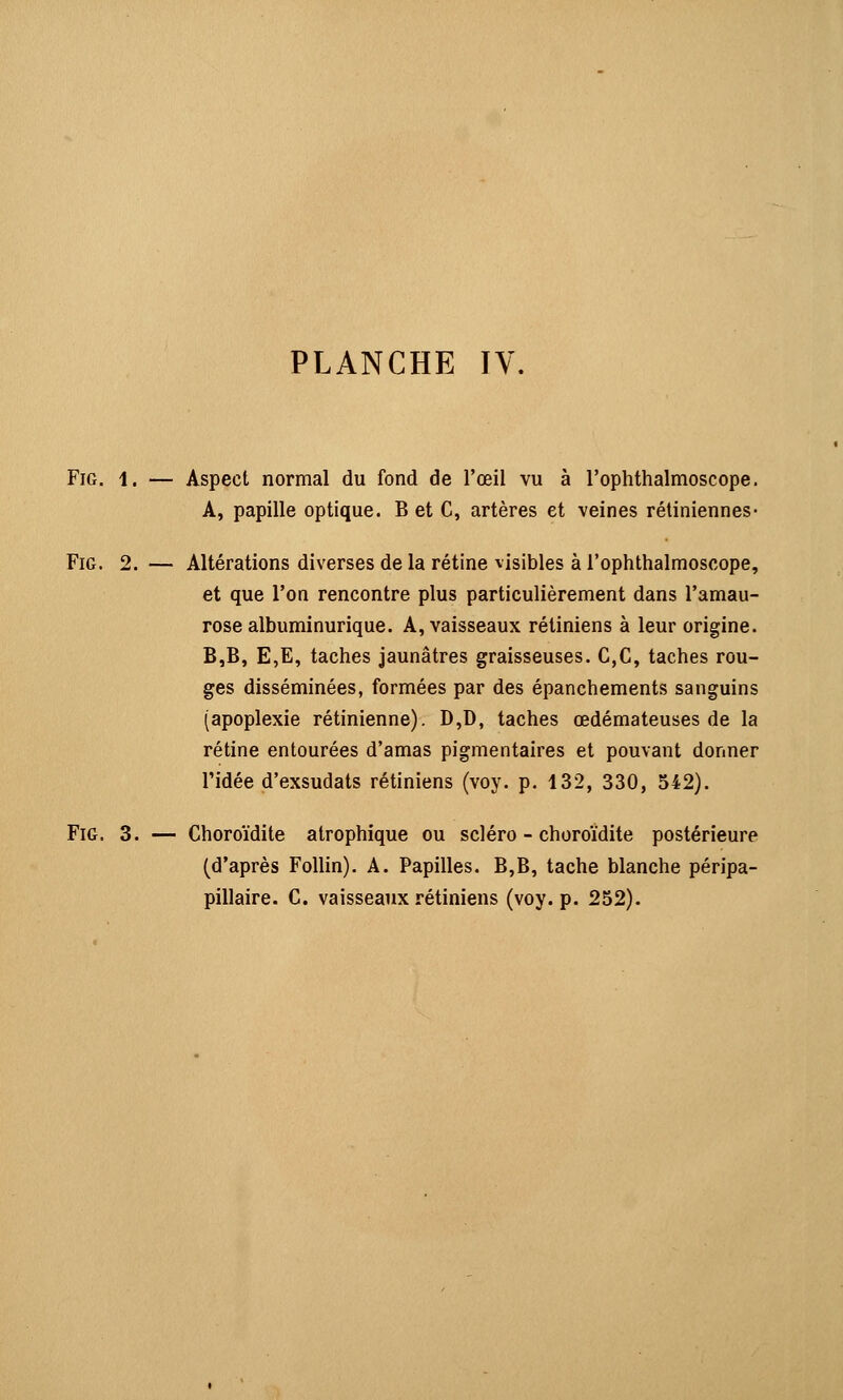 Fig. 1. — Aspect normal du fond de l'œil vu à l'ophthalmoscope. A, papille optique. B et C, artères et veines rétiniennes- Fig. 2. — Altérations diverses de la rétine visibles à l'ophthalmoscope, et que l'on rencontre plus particulièrement dans l'amau- rose albuminurique. A, vaisseaux rétiniens à leur origine. B,B, E,E, taches jaunâtres graisseuses. C,C, taches rou- ges disséminées, formées par des épanchements sanguins (apoplexie rétinienne). D,D, taches œdémateuses de la rétine entourées d'amas pigmentaires et pouvant donner l'idée d'exsudats rétiniens (voy. p. 432, 330, 542). Fig. 3. — Choroïdite atrophique ou scléro - choroïdite postérieure (d'après Follin). A. Papilles. B,B, tache blanche péripa- pillaire. C. vaisseaux rétiniens (voy. p. 252).