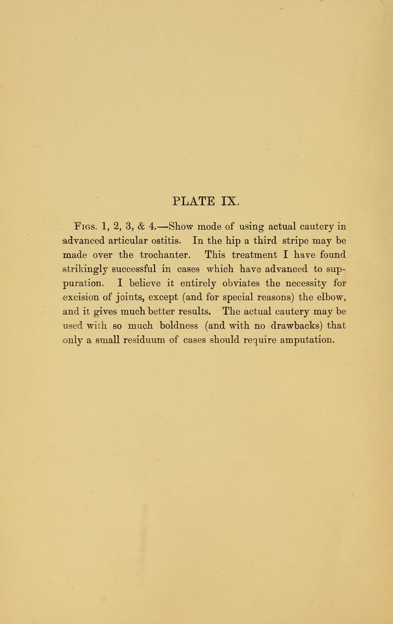 Tigs. 1, 2, 3, & 4.—Show mode of using actual cautery in advanced articular ostitis. In the hip a third stripe may be made over the trochanter. This treatment I have found strikingly successful in cases which have advanced to sup- puration. I believe it entirely obviates the necessity for excision of joints, except (and for special reasons) the elbow, and it gives much better results. The actual cautery may be used with so much boldness (and with no drawbacks) that only a small residuum of cases should require amputation.