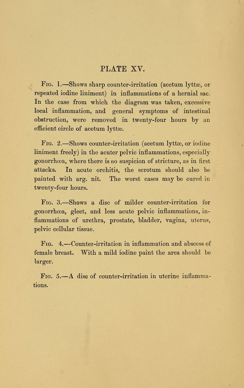 Fig. 1.—Skows sharp counter-irritation (acetum lyttse, or repeated iodine liniment) in inflammations of a hernial sac. In the case from which the diagram was taken, excessive local inflammation, and general symptoms of intestinal obstruction, were removed in twenty-four hours by an efficient circle of acetum lyttse. Fig. 2.—Shows counter-irritation (acetum lyttae, or iodine liniment freely) in the acuter pelvic inflammations, especially gonorrhoea, where there is no suspicion of stricture, as in first attacks. In acute orchitis, the scrotum should also be painted with arg. nit. The worst cases may be cured in twenty-four hours. Fig. 3.—Shows a disc of milder counter-irritation for gonorrhoea, gleet, and less acute pelvic inflammations, in- flammations of urethra, prostate, bladder, vagina, uterus, pelvic cellular tissue. Fig. 4.—Counter-irritation in inflammation and abscess of female breast. With a mild iodine paint the area should be larger. Fig. 5.—A disc of counter-irritation in uterine inflamma- tions.