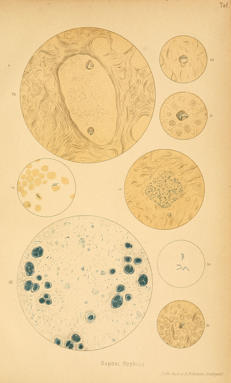 Kaposi, Syphilis ZiffuATtsi. v.J. EcJrSteiji ,Stait^art