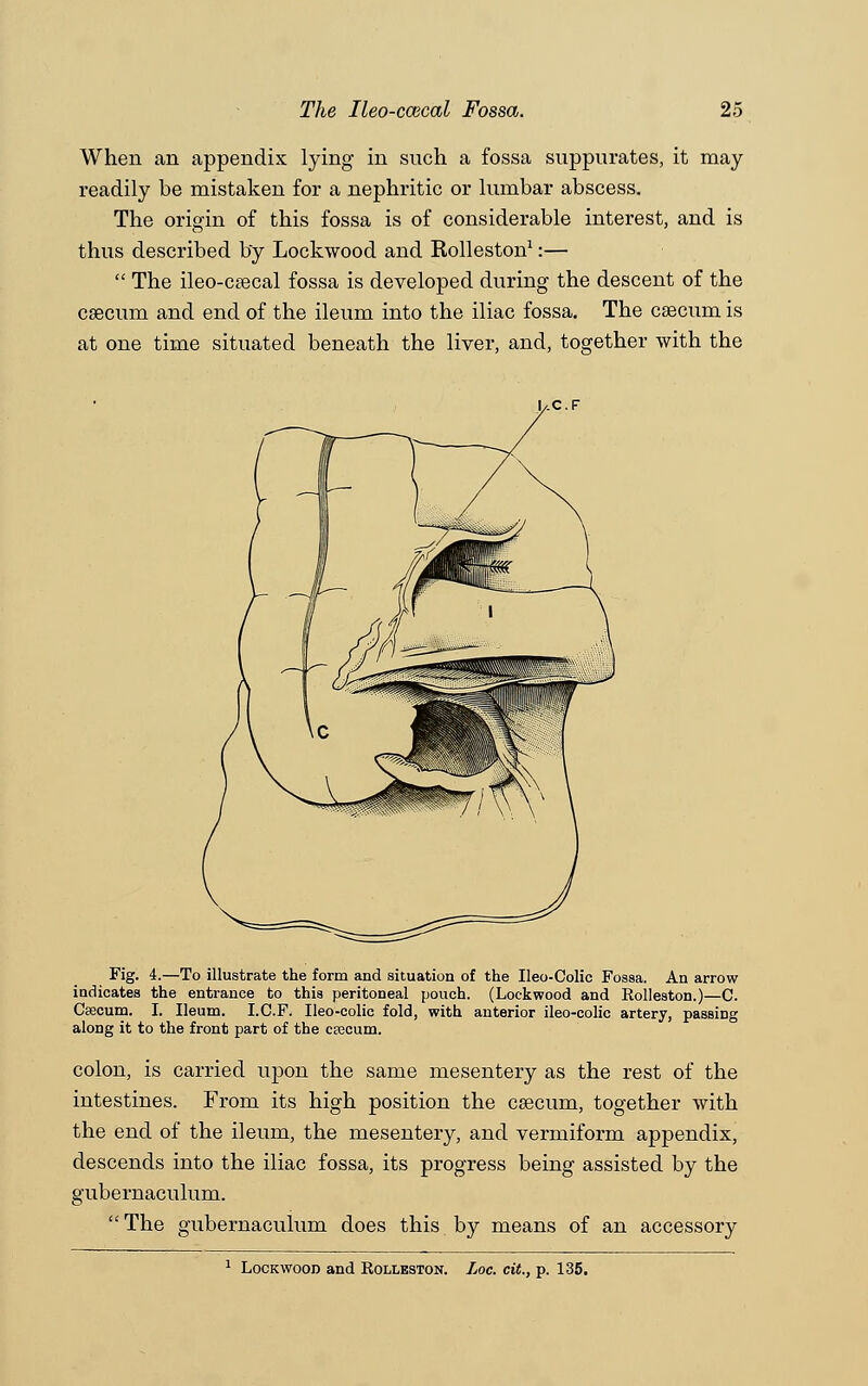 When an appendix lying in such a fossa suppurates, it may readily be mistaken for a nephritic or lumbar abscess. The origin of this fossa is of considerable interest, and is thus described by Lockwood and Rolleston1:— The ileo-caecal fossa is developed during the descent of the caecum and end of the ileum into the iliac fossa. The caecum is at one time situated beneath the liver, and, together with the Fig. 4.—To illustrate the form and situation of the Ileo-Colic Fossa. An arrow indicates the entrance to this peritoneal pouch. (Lockwood and Kolleston.)—C. Caecum. I. Ileum. I.C.F. Ueo-colic fold, with anterior ileo-colic artery, passing along it to the front part of the cEecum. colon, is carried upon the same mesentery as the rest of the intestines. From its high position the caecum, together with the end of the ileum, the mesentery, and vermiform appendix, descends into the iliac fossa, its progress being assisted by the gubernaculum. The gubernaculum does this by means of an accessory 1 Lockwood and Rolleston. Loc. cit., p. 135.