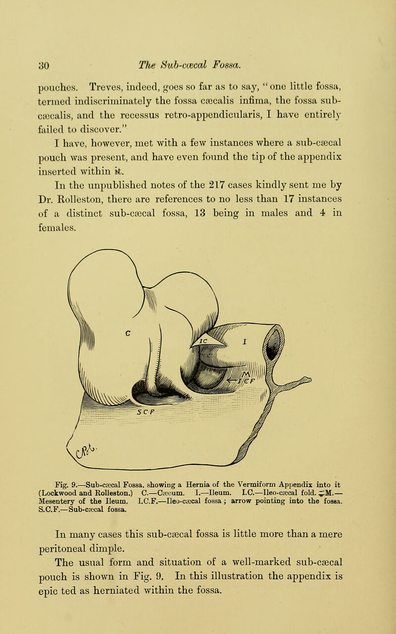 pouches. Treves, indeed, goes so far as to say, one little fossa, termed indiscriminately the fossa csecalis infima, the fossa sub- csecalis, and the rccessus retro-appendicularis, I have entirely failed to discover. I have, however, met with a few instances where a sub-csecal pouch was present, and have even found the tip of the appendix inserted within k. In the unpublished notes of the 217 cases kindly sent me by Dr. Kolleston, there are references to no less than 17 instances of a distinct sub-csecal fossa, 13 being in males and 4 in females. Fig. 9.—Sub-crecal Fossa. showiDg a Hernia of the Vermiform Appendix into it (Lockwood and Rolleston.) C.—Crecum. I.—Ileum. I.C.—Ileo-ceecal fold. ^M.— Mesentery of the Ileum. I.C.F.—Ileo-ctecal fossa; arrow pointing into the fosBa. S. C. F.— Sub-crocal fossa. In many cases this sub-csecal fossa is little more than a mere peritoneal dimple. The usual form and situation of a well-marked sub-csecal pouch is shown in Fig. 9. In this illustration the appendix is epic ted as herniated within the fossa.