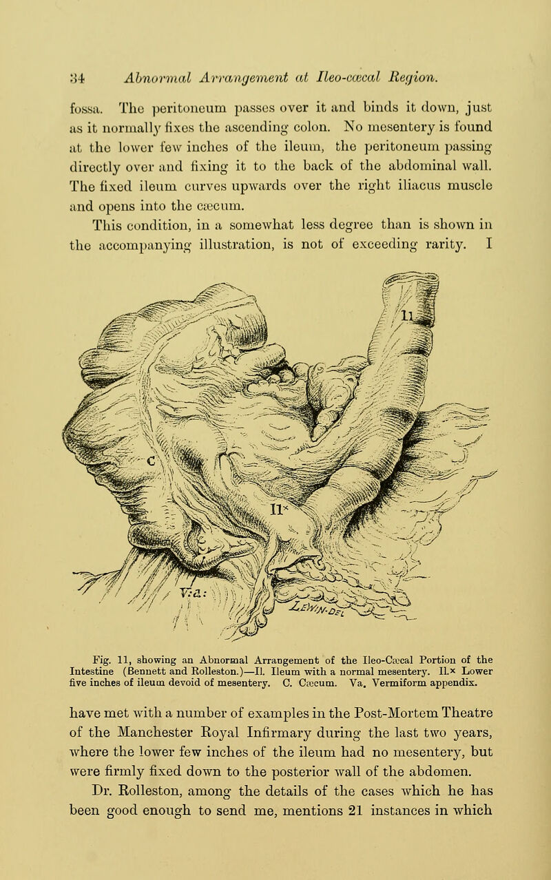 fossa. The peritoneum passes over it and binds it down, just as it normally fixes the ascending colon. No mesentery is found at the lower few inches of the ileum, the peritoneum passing directly over and fixing it to the back of the abdominal wall. The fixed ileum curves upwards over the right iliacus muscle and opens into the caecum. This condition, in a somewhat less degree than is shown in the accompanying illustration, is not of exceeding rarity. I Fig. 11, showing an Abnormal Arrangement of the Ileo-Csucal Portion of the Intestine (Bennett and Rolleston.)—II. Ileum with a normal mesentery. II. x Lower five inches of ileum devoid of mesentery. C. Ciecum. Va. Vermiform appendix. have met with a number of examples in the Post-Mortem Theatre of the Manchester Royal Infirmary during the last two years, where the lower few inches of the ileum had no mesentery, but were firmly fixed down to the posterior wall of the abdomen. Dr. Rolleston, among the details of the cases Avhich he has been good enough to send me, mentions 21 instances in which
