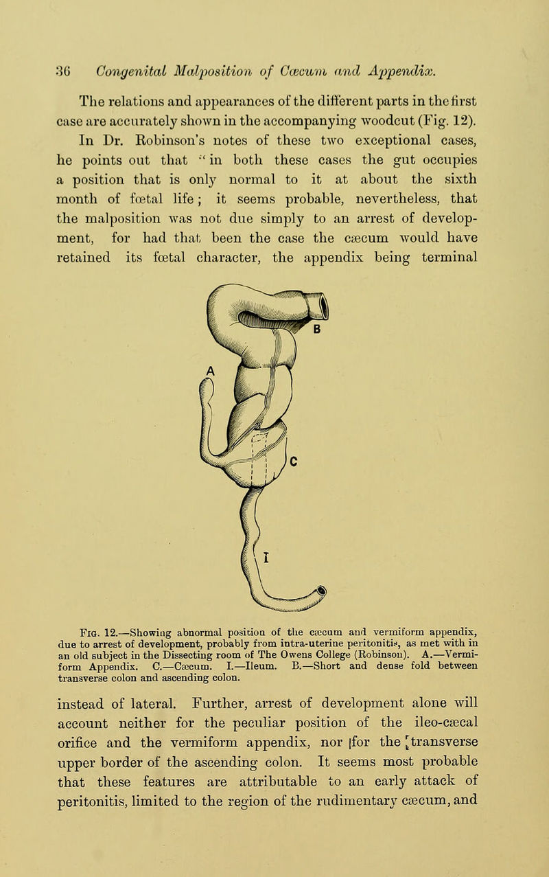 The relations and appearances of the different parts in the first case are accurately shown in the accompanying woodcut (Fig. 12). In Dr. Robinson's notes of these two exceptional cases, he points out that  in both these cases the gut occupies a position that is only normal to it at about the sixth month of foetal life; it seems probable, nevertheless, that the malposition was not due simply to an arrest of develop- ment, for had that been the case the caecum would have retained its fcetal character, the appendix being terminal Fig. 12.—Showing abnormal position of the csecum and vermiform appendix, due to arrest of development, probably from intra-uterine peritonitis, as met with in an old subject in the Dissecting room of The Owens College (Robinson). A.—Vermi- form Appendix. C.—Ctecum. I.—Ileum. B.—Short and dense fold between transverse colon and ascending colon. instead of lateral. Further, arrest of development alone will account neither for the peculiar position of the ileo-ceecal orifice and the vermiform appendix, nor [for the [transverse upper border of the ascending colon. It seems most probable that these features are attributable to an early attack of peritonitis, limited to the region of the rudimentary csecum, and