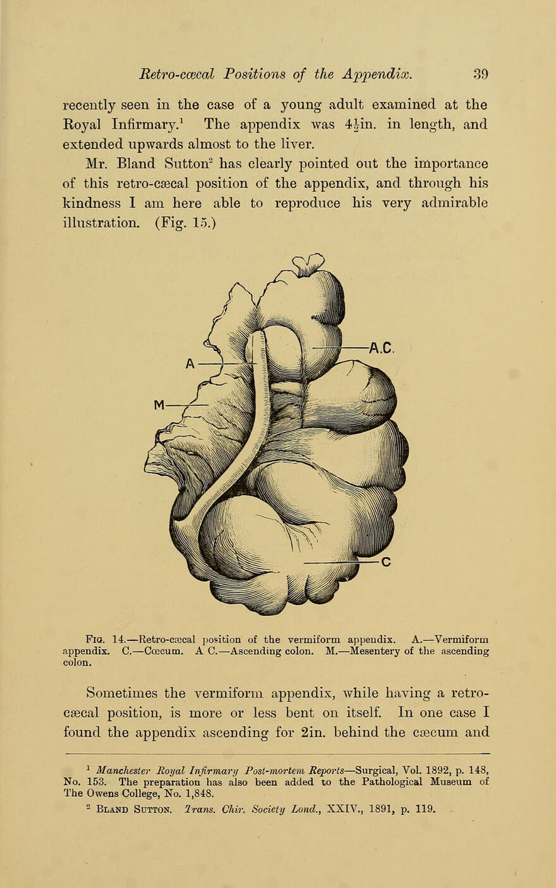 recently seen in the case of a young adult examined at the Royal Infirmary.1 The appendix was 4Mn. in length, and extended upwards almost to the liver. Mr. Bland Sutton2 has clearly pointed out the importance of this retro-csecal position of the appendix, and through his kindness I am here able to reproduce his very admirable illustration. (Fig. 15.) Fia. 14.—Retro-ccecal position of the vermiform appeodix. A.—Vermiform appendix. 0.—Coecum. A C.—Ascending colon. M.—Mesentery of the ascending colon. Sometimes the vermiform appendix, while having a retro- csecal position, is more or less bent on itself. In one case I found the appendix ascending for 2in. behind the caecum and 1 Manchester Royal Infirmary Post-mortem Reports—Surgical, Vol. 1892, p. 148, No. 153. The preparation has also been added to the Pathological Museum of The Owens College, No. 1,848. 2 Bland Sutton. Trans. Chir. Society Loncl., XXIV., 1891, p. 119.