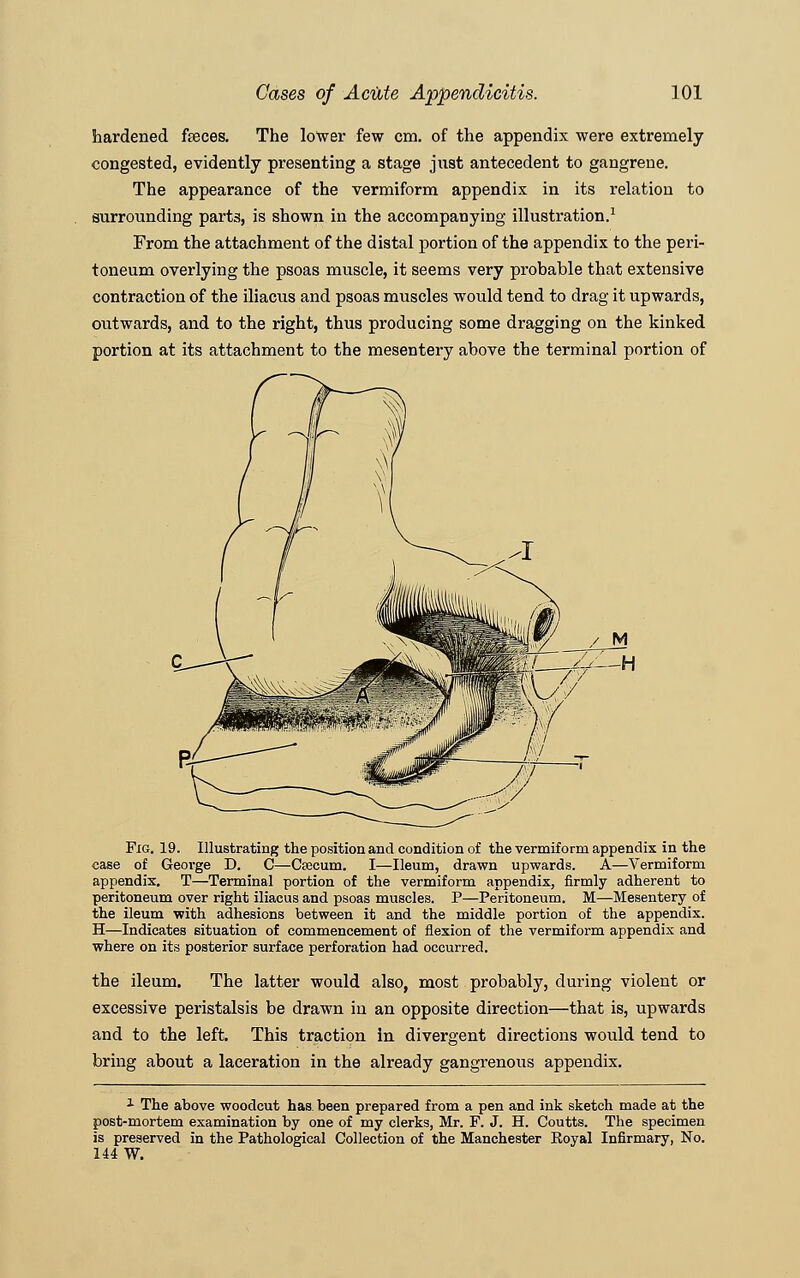 hardened fseces. The lower few cm. of the appendix were extremely congested, evidently presenting a stage jnst antecedent to gangrene. The appearance of the vermiform appendix in its relation to surrounding parts, is shown in the accompanying illustration.1 From the attachment of the distal portion of the appendix to the peri- toneum overlying the psoas muscle, it seems very probable that extensive contraction of the iliacus and psoas muscles would tend to drag it upwards, outwards, and to the right, thus producing some dragging on the kinked portion at its attachment to the mesentery above the terminal portion of Fig. 19. Illustrating the position and condition of the vermiform appendix in the case of George D. C—Caecum. I—Ileum, drawn upwards. A—Vermiform appendix. T—Terminal portion of the vermiform appendix, firmly adherent to peritoneum over right iliacus and psoas muscles. P—Peritoneum. M—Mesentery of the ileum with adhesions between it and the middle portion of the appendix. H—Indicates situation of commencement of flexion of the vermiform appendix and where on its posterior surface perforation had occurred. the ileum. The latter would also, most probably, during violent or excessive peristalsis be drawn in an opposite direction—that is, upwards and to the left. This traction in divergent directions would tend to bring about a laceration in the already gangrenous appendix. 1 The above woodcut has. been prepared from a pen and ink sketch made at the post-mortem examination by one of my clerks, Mr. F. J. H. Coutts. The specimen is preserved in the Pathological Collection of the Manchester Royal Infirmary, No. 144 W.