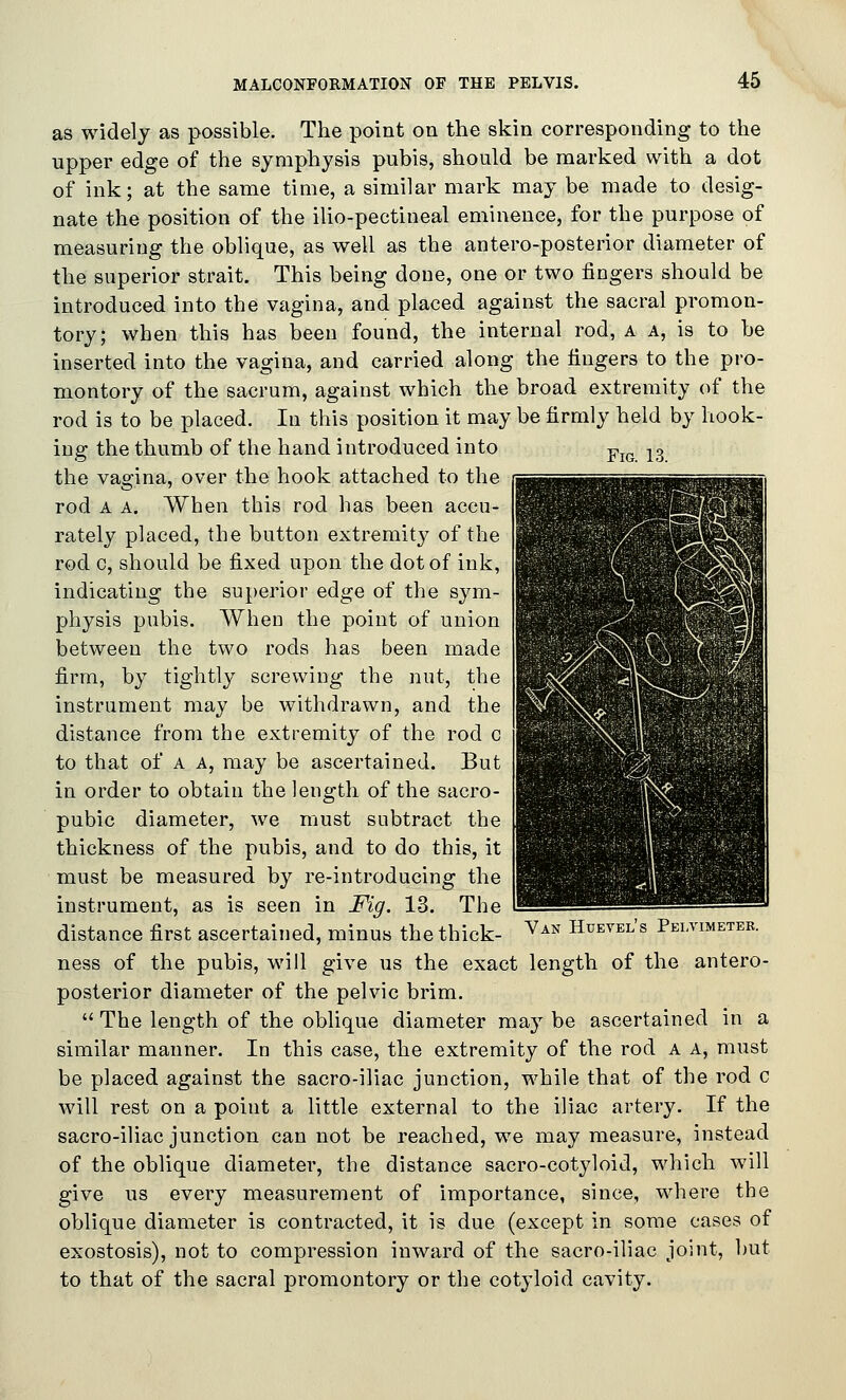 Fig. 13. as widely as possible. The point on the skin corresponding to the upper edge of the symphysis pubis, should be marked with a dot of ink; at the same time, a similar mark may be made to desig- nate the position of the ilio-pectineal eminence, for the purpose of measuring the oblique, as well as the antero-posterior diameter of the superior strait. This being done, one or two fingers should be introduced into the vagina, and placed against the sacral promon- tory; when this has been found, the internal rod, a a, is to be inserted into the vagina, and carried along the fingers to the pro- montory of the sacrum, against which the broad extremity of the rod is to be placed. In this position it may be firmly held by hook- ing the thumb of the hand introduced into the vagina, over the hook attached to the rod A A. When this rod has been accu- rately placed, the button extremity of the rod c, should be fixed upon the dot of ink, indicating the superior edge of the sym- physis pubis. When the point of union between the two rods has been made firm, by tightly screwing the nut, the instrument may be withdrawn, and the distance from the extremity of the rod c to that of A A, may be ascertained. But in order to obtain the length of the sacro- pubic diameter, we must subtract the thickness of the pubis, and to do this, it must be measured by re-introducing the instrument, as is seen in Fig. 13. The distance first ascertained, minus the thick- ^^^ Hueyel's Pelvimeter. ness of the pubis, will give us the exact length of the antero- posterior diameter of the pelvic brim.  The length of the oblique diameter may be ascertained in a similar manner. In this case, the extremity of the rod a a, must be placed against the sacro-iliac junction, while that of the rod c will rest on a point a little external to the iliac artery. If the sacro-iliac junction can not be reached, we may measure, instead of the oblique diameter, the distance sacro-cotyloid, which will give us every measurement of importance, since, where the oblique diameter is contracted, it is due (except in some cases of exostosis), not to compression inward of the sacro-iliac joint, but to that of the sacral promontory or the cotyloid cavity.