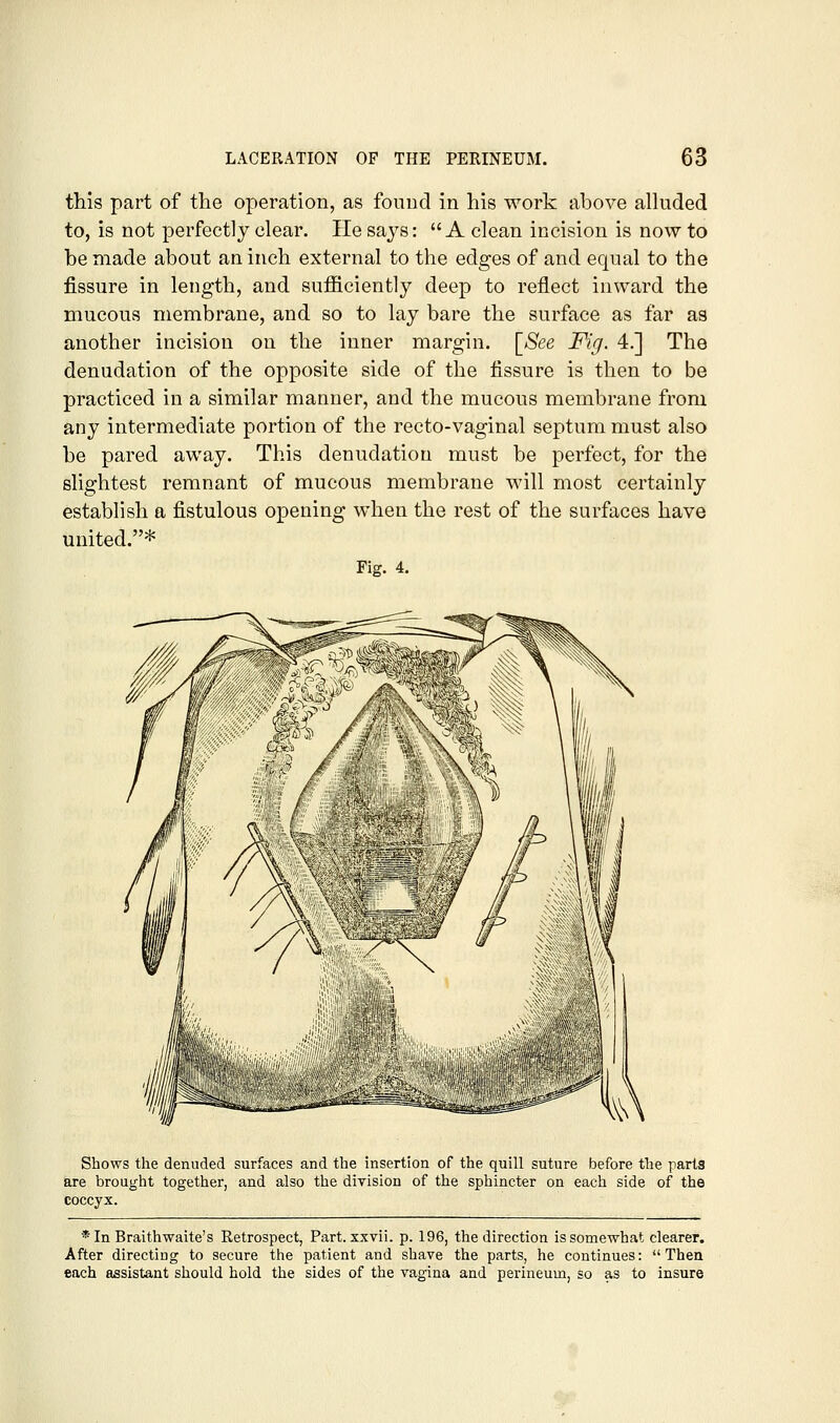 this part of the operation, as found in his work above alkided to, is not perfectly clear. He says:  A clean incision is now to be made about an inch external to the edges of and equal to the fissure in length, and sufficiently deep to reflect inward the mucous membrane, and so to lay bare the surface as far as another incision on the inner margin. [^See Fig. 4.] The denudation of the opposite side of the fissure is then to be practiced in a similar manner, and the mucous membrane from any intermediate portion of the recto-vaginal septum must also be pared away. This denudation must be perfect, for the slightest remnant of mucous membrane will most certainly establish a fistulous opening when the rest of the surfaces have united.* Fig. 4. Shows the denuded surfaces and the insertion of the quill suture before the parts are brought together, and also the division of the sphincter on each side of the coccyx. * In Braithwaite's Retrospect, Part, xxvii. p. 196, the direction is somewhat clearer. After directing to secure the patient and shave the parts, he continues: Then each assistant should hold the sides of the vagina and perineum, so as to insure
