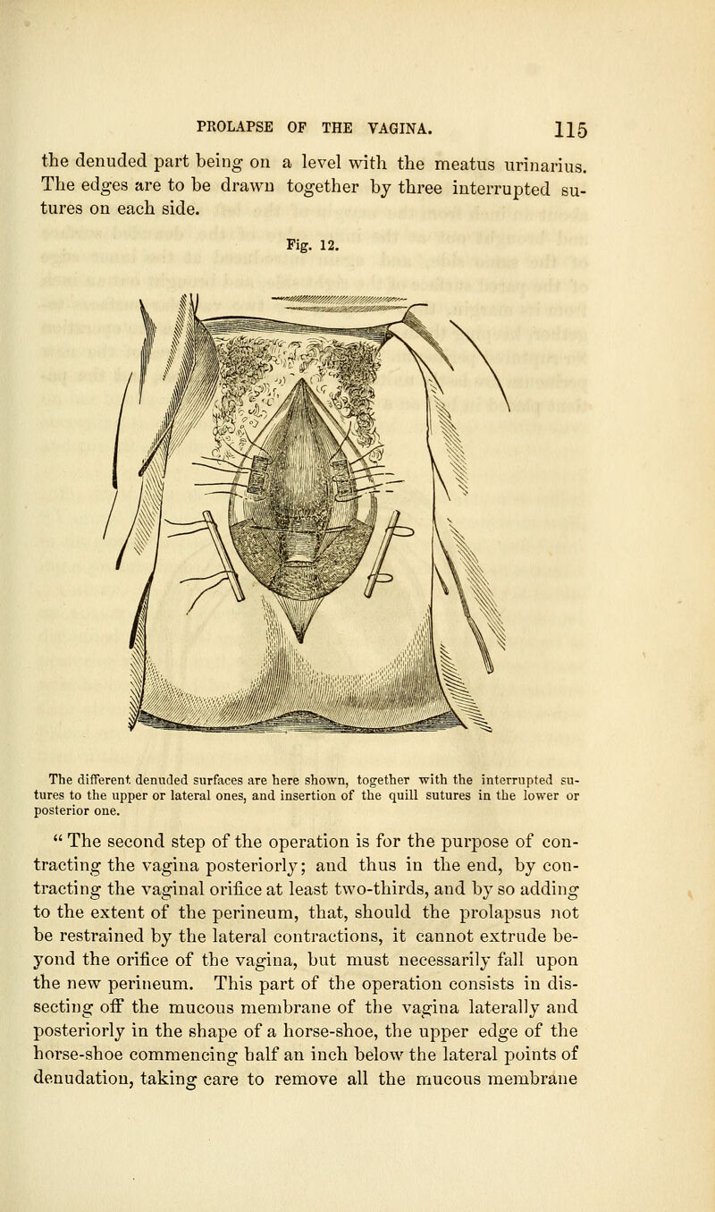 the denuded part being on a level with the meatus urinarius. The edges are to be drawn together by three interrupted su- tures on each side. Fig. 12. The different denuded surfaces are here shown, together with the interrupted su- tures to the upper or lateral ones, and insertion of the quill sutures in the lower or posterior one.  The second step of the operation is for the purpose of con- tracting the vagina posteriorly; and thus in the end, by con- tracting the vaginal orifice at least two-thirds, and by so adding to the extent of the perineum, that, should the prolapsus not be restrained by the lateral contractions, it cannot extrude be- yond the orifice of the vagina, but must necessarily fall upon the new perineum. This part of the operation consists in dis- secting off the mucous membrane of the vagina laterally and posteriorly in the shape of a horse-shoe, the upper edge of the horse-shoe commencing half an inch below the lateral points of denudation, taking- care to remove all the mucous membrane