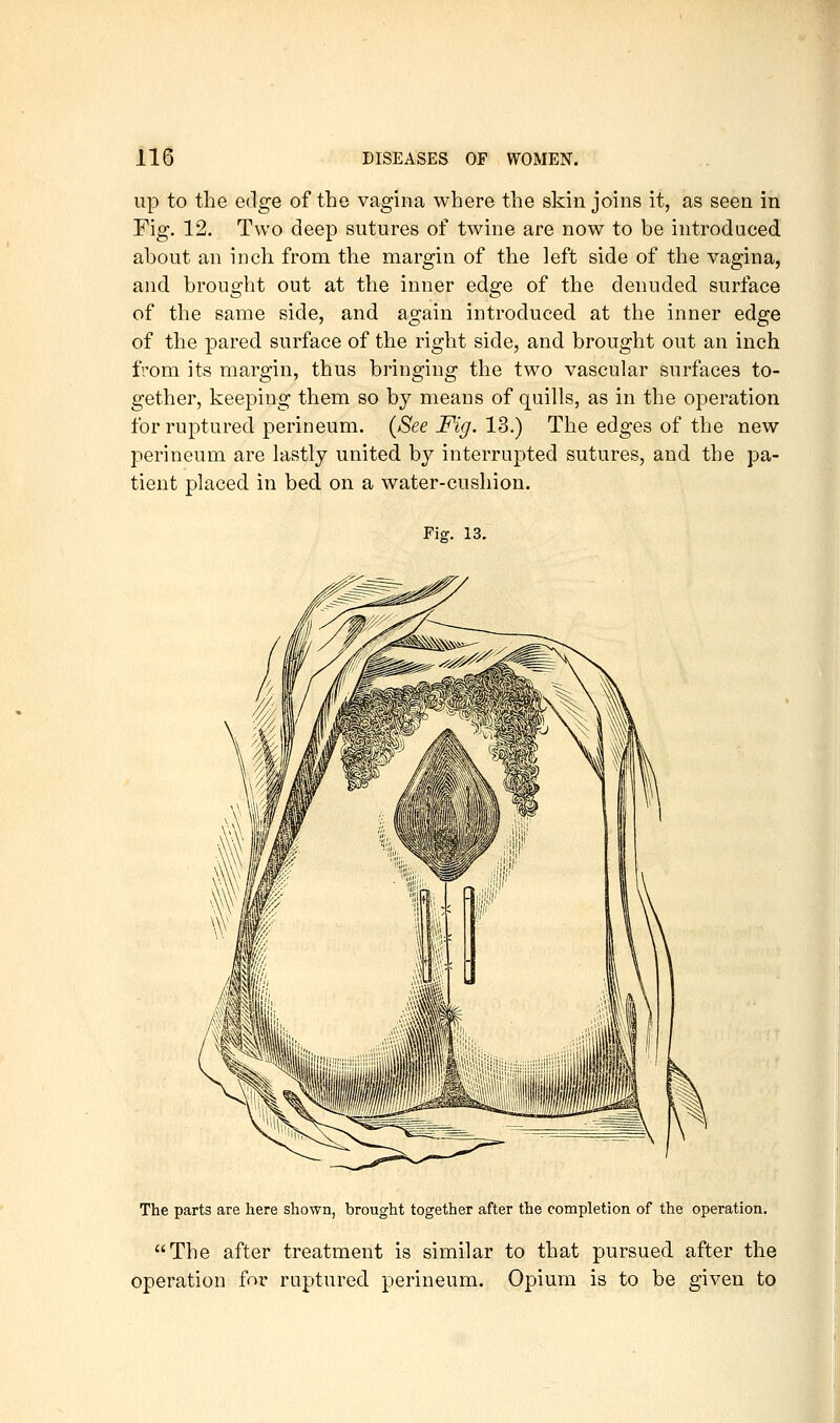 up to the edge of the vagina where the skin joins it, as seen in Fig. 12. Two deep sutures of twine are now to be introduced about an inch from the margin of the left side of the vagina, and brought out at the inner edge of the denuded surface of the same side, and again introduced at the inner edge of the pared surface of the right side, and brought out an inch from its margin, thus bringing the two vascular surfaces to- gether, keeping them so by means of quills, as in the operation for ruptured perineum. (See Fig. 13.) The edges of the new perineum are lastly united by interrupted sutures, and the pa- tient placed in bed on a water-cushion. Fig. 13. The parts are here shown, brought together after the completion of the operation. The after treatment is similar to that pursued after the operation foi- ruptured perineum. Opium is to be given to