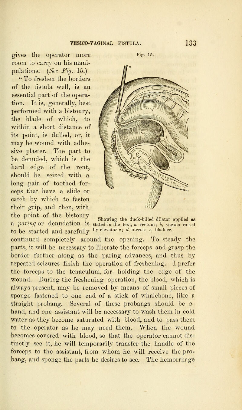 gives the operator more Fig. 15. room to carry on his mani- pulations. i^See Fig. 15.)  To freshen the borders of the fistula well, is an essential part of the opera- tion. It is, generally, best performed with a bistoury, the blade of which, to within a short distance of its point, is dulled, or, it may be wound with adhe- sive plaster. The part to be denuded, which is the hard edge of the rent, should be seized with a long pair of toothed for- ceps that have a slide or catch by which to fasten their grip, and then, with the point of the bistoury „, . , ,,,.,,. ^ , , . . Showing the duck-billed dilator applied aa a paring or denudation is stated in the text, a, rectum; b, vagina raised to be started and carefully by elevator c; cf, uterus; e, bladder. continued completely around the opening. To steady the parts, it will be necessary to liberate the forceps and grasp the border further along as the paring advances, and thus by repeated seizures finish the operation of freshening. I prefer the forceps to the tenaculum, for holding the edge of the wound. During the freshening operation, the blood, which is always present, may be removed by means of small pieces of sponge fastened to one end of a stick of whalebone, like d straight probang. Several of these probangs should be a. hand, and one assistant will be necessary to wash them in cold water as they become saturated with blood, and to j)ass them to the operator as he may need them. When the wound becomes covered with blood, so that the operator cannot dis- tinctly see it, he will temporarily transfer the handle of the forceps to the assistant, from whom he will receive the pro- bang, and sponge the parts he desires to see. The hemorrhage