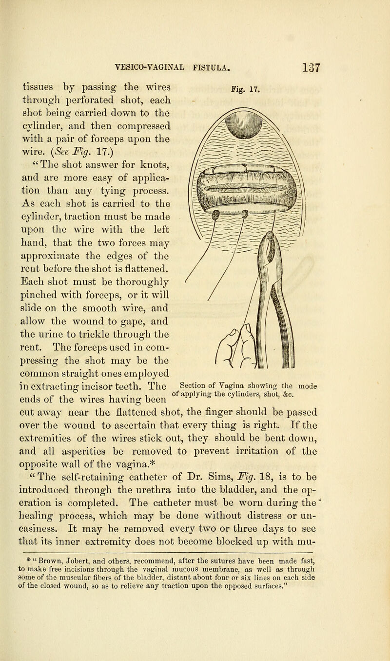 Fig. 17. tissues by passing the wires through perforated shot, each shot being carried down to the cyhnder, and then compressed with a pair of forceps upon the wire. {See Fig. 17.)  The shot answer for knots, and are more easy of appHca- tion than any tying process. As each shot is carried to the cylinder, traction must be made upon the wire with the left hand, that the two forces may approximate the edges of the rent before the shot is flattened. Each shot must be thoroughly pinched with forceps, or it will slide on the smooth wire, and allow the wound to gape, and the urine to trickle through the rent. The forceps used in com- pressing the shot may be the common straight ones employed in extracting incisor teeth. The ends of the wires having been cut away near the flattened shot, the finger should be passed over the wound to ascertain that every thing is right. If the extremities of the wires stick out, they should be bent down, and all asperities be removed to prevent irritation of the opposite wall of the vagina.*  The self-retaining catheter of Dr. Sims, Fig. 18, is to be introduced through the urethra into the bladder, and the op- eration is completed. The catheter must be worn during the healing process, which may be done without distress or un- easiness. It may be removed every two or three days to see that its inner extremity does not become blocked up with mu- *  Brown, Jobert, and others, recommend, after the sutures have been made fast, to make free incisions through the vaginal raucous membrane, as well as through some of the muscular fibers of the bladder, distant about four or six lines on each side of the closed wound, so as to relieve any traction upon the opposed surfaces. Section of Vagina showing the mode of applying the cylinders, shot, &c.