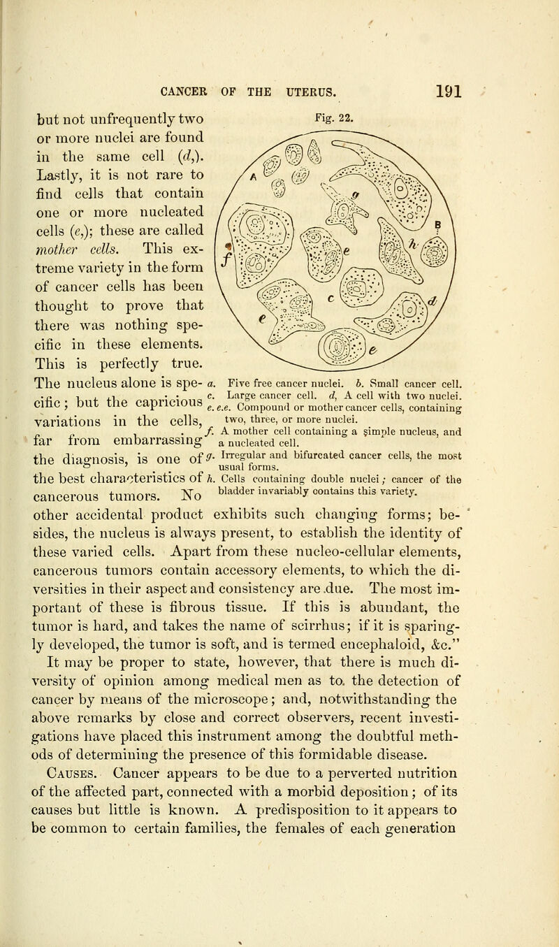 but not unfrequently two Eig. 22. or more nuclei are found in the same cell (d,). Lastly, it is not rare to find cells that contain one or more nucleated cells (e,); these are called mother cells. This ex- treme variety in the form of cancer cells has been thought to prove that there was nothing spe- cific in these elements. This is perfectly true. The nucleus alone is Spe- a. Five free cancer nuclei, b. Small cancer cell, ■■fi V. f fl ' i na ''■ I^^^'o® cancer cell, d, A cell with two nuclei. cmc ; out tne capricious ^^^ q^j^^pq^^.j ^j. jjjQj.jjgj.p^jj^gj.^.pjjg^ ^.^^j^^g^jj^j^jg variations in the cells, two, three, or more nuclei. , . /. A mother cell containing a §imple nucleus, and far from embarrassing a nucleated cell. the diao'nosis is one of^* irregular and bifurcated cancer cells, the most '=' ' _ _ usual forms. the best characteristics of h. Cells containing double nuclei; cancer of the cancerous tumors. No ^^^^^^' iiwariably contains this variety. other accidental product exhibits such changing forms; be- sides, the nucleus is always present, to establish the identity of these varied cells. Apart from these nucleo-eellular elements, cancerous tumors contain accessory elements, to which the di- versities in their aspect and consistency are .due. The most im- portant of these is fibrous tissue. If this is abundant, the tumor is hard, and takes the name of scirrhus; if it is sparing- ly developed, the tumor is soft, and is termed encephaloid, &c. It may be proper to state, however, that there is much di- versity of opinion among medical men as to. the detection of cancer by means of the microscope; and, notwithstanding the above remarks by close and correct observers, recent investi- gations have placed this instrument among the doubtful meth- ods of determining the presence of this formidable disease. Causes. Cancer appears to be due to a perverted nutrition of the affected part, connected with a morbid deposition; of its causes but little is known. A predisposition to it appears to be common to certain families, the females of each generation