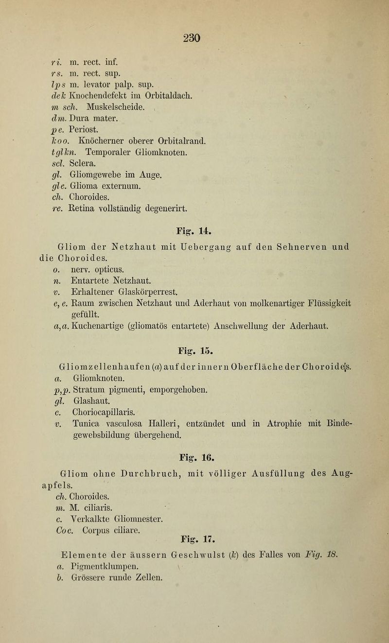 ri. m. rect. inf. rs. m. rect. sup. Ips m. levator palp. sup. dek Knochendefekt im Orbitaldach. m scli. Muskelscheide. ( dm. Dura mater. pe. Periost. leoo. Knöcherner oberer Orbitalrand. tglTcn. Temporaler Gliomknoten. sei. Sclera. gl. Gliomgewebe im Auge. gle. Glioma externum. eh. Choroides. re. Retina vollständig degenerirt. Fig. 14. Gliom der Netzhaut mit Uebergang auf den Sehnerven und die Choroides. o. nerv, opticus. n. Entartete Netzhaut. v. Erhaltener Glaskörperrest. e, e. Raum zwischen Netzhaut und Aderhaut von molkenartiger Flüssigkeit gefüllt, a, a. Kuchenartige (gliomatös entartete) Anschwellung der Aderhaut. Gliomzellenhaufen(a)auf der inner n Ob er f lache, der Chor oide[s. a. Gliomknoten. p,p. Stratum pigmenti, emporgehoben. gl. Glashaut. c. Choriocapillaris. v. Tunica vasculosa Halleri, entzündet und in Atrophie mit Binde- gewebsbildung übergehend. Fig. 16. Gliom ohne Durchbruch, mit völliger Ausfüllung des Aug- apfels. cli. Choroides. m. M. ciliaris. c. Verkalkte Gliomnester. Coc. Corpus ciliare. Fig. 17. Elemente der äussern Geschwulst (Ic) des Falles von Fig. 18. a. Pigmentklumpen. b. Grössere runde Zellen.