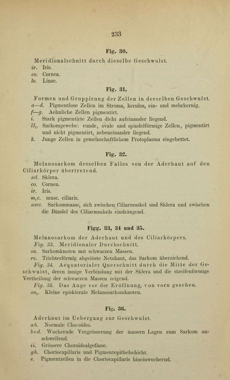 Fig. 30. Meridionalschnitt durch dieselbe Geschwulst. ir. Iris. co. Cornea. le. Linse. Fig. 31. Formen und Gruppirung der Zellen in derselben Geschwulst. a—d. Pigmentlose Zellen im Stroma, kernlos, ein- und mehrkernig. f— g. Aehnliche Zellen pigmentirt. i. Stark pigmentirte Zellen dicht aufeinander liegend. llx. Sarkomgewebe: runde, ovale und spindelförmige Zellen, pigmentirt und nicht pigmentirt, nebeneinander liegend. h Junge Zellen in gemeinschaftlichem Protoplasma eingebettet. Fig. 32. Melanosarkom desselben Falles von der Aderhaut auf den Ciliarkörper übertretend. sei. Sklera. co. Cornea. ir. Iris. m,c. musc. ciliaris. sarc. Sarkommasse, sich zwischen Ciliarmuskel und Sklera und zwischen die Bündel des Ciliarmuskels eindrängend. Figg. 33? 34 und 35. Melanosarkom der Aderhaut und des Ciliarkörpers. Fig. 33. Meridionaler Durchschnitt. sa. Sarkomknoten mit schwarzen Massen. re. Trichterförmig abgelöste Netzhaut, das Sarkom überziehend. Fig. 34. Aequatorialer Querschnitt durch die Mitte der Ge- schwulst, deren innige Verbindung mit der Sklera und die streifenförmige Yertheilung der schwarzen Massen zeigend. Fig. 35. Das Auge vor der Eröffnung, von vorn gesehen. sax. Kleine episklerale Melanosarkomknoten. Fig. 36. Aderhaut im Uebergang zur Geschwulst. ab. Normale Choroides. ocd. Wuchernde Yergrösserung der äussern Lagen zum Sarkom an- schwellend. ii. Grössere Choroidealgefässe. gli. Choriocapillaris und Pigmentepithelschicht. e. Pigmentzellen in die Choriocapillaris hineinwuchernd,