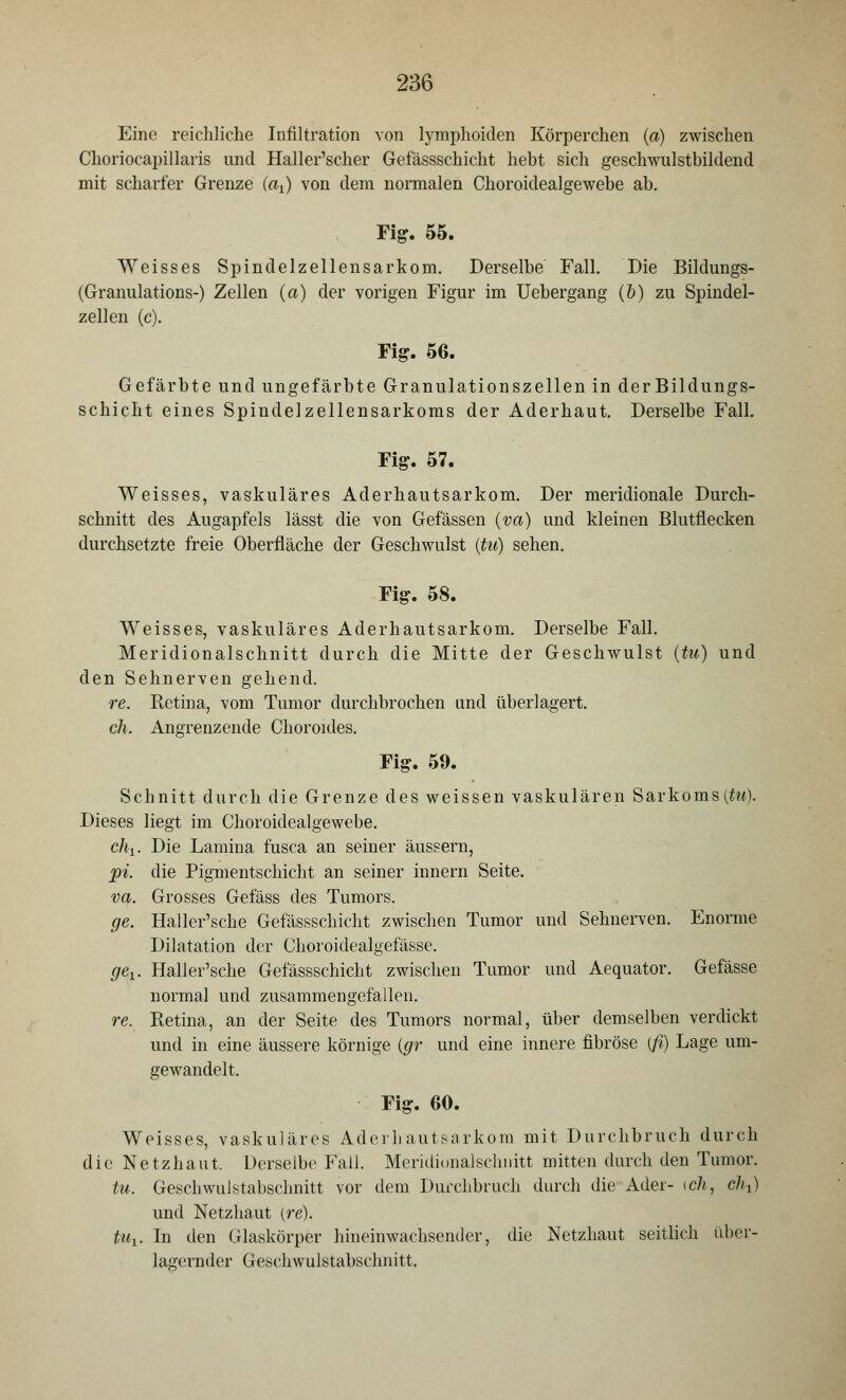 Eine reichliche Infiltration von lymphoiden Körperchen (a) zwischen Choriocapillaris und Haller'scher Gefässschicht hebt sich geschwulstbildend mit scharfer Grenze (ax) von dem normalen Choroidealgewebe ab. Fig. 55. Weisses Spindelzellensarkom. Derselbe Fall. Die Bildungs- (Granulations-) Zellen (a) der vorigen Figur im Uebergang (b) zu Spindel- zellen (c). Fig. 56. Gefärbte und ungefärbte Granulationszellen in derBildungs- schicht eines Spindelzellensarkoms der Aderhaut. Derselbe Fall. Fig. 57. Weisses, vaskuläres Aderhautsarkom. Der meridionale Durch- schnitt des Augapfels lässt die von Gefässen (va) und kleinen Blutflecken durchsetzte freie Oberfläche der Geschwulst (tu) sehen. Fig. 58. Weisses, vaskuläres Aderhautsarkom. Derselbe Fall. Meridionalschnitt durch die Mitte der Geschwulst (tu) und den Sehnerven gehend. re. Retina, vom Tumor durchbrochen und überlagert. eh. Angrenzende Choroides. Fig. 59. Schnitt durch die Grenze des weissen vaskulären Sarkoms (tu). Dieses liegt im Choroidealgewebe. chx. Die Lamina fusca an seiner äussern, pi. die Pigmentschicht an seiner innern Seite. va. Grosses Gefäss des Tumors. ge. Haller'sche Gefässschicht zwischen Tumor und Sehnerven. Enorme Dilatation der Choroidealgefässe. get. Haller'sche Gefässschicht zwischen Tumor und Aequator. Gefässe normal und zusammengefallen. re. Retina, an der Seite des Tumors normal, über demselben verdickt und in eine äussere körnige (gr und eine innere fibröse (fi) Lage um- gewandelt. Fig. 60. Weisses, vaskuläres Aderhautsarkom mit Durchbruch durch die Netzhaut. Derselbe Fall. Meridionalschnitt mitten durch den Tumor. tu. Geschwulstabschnitt vor dem Durchbruch durch die Ader- ich, eht) und Netzhaut (re). tux. In den Glaskörper hineinwachsender, die Netzhaut seitlich über- lagernder Geschwulstabschnitt,