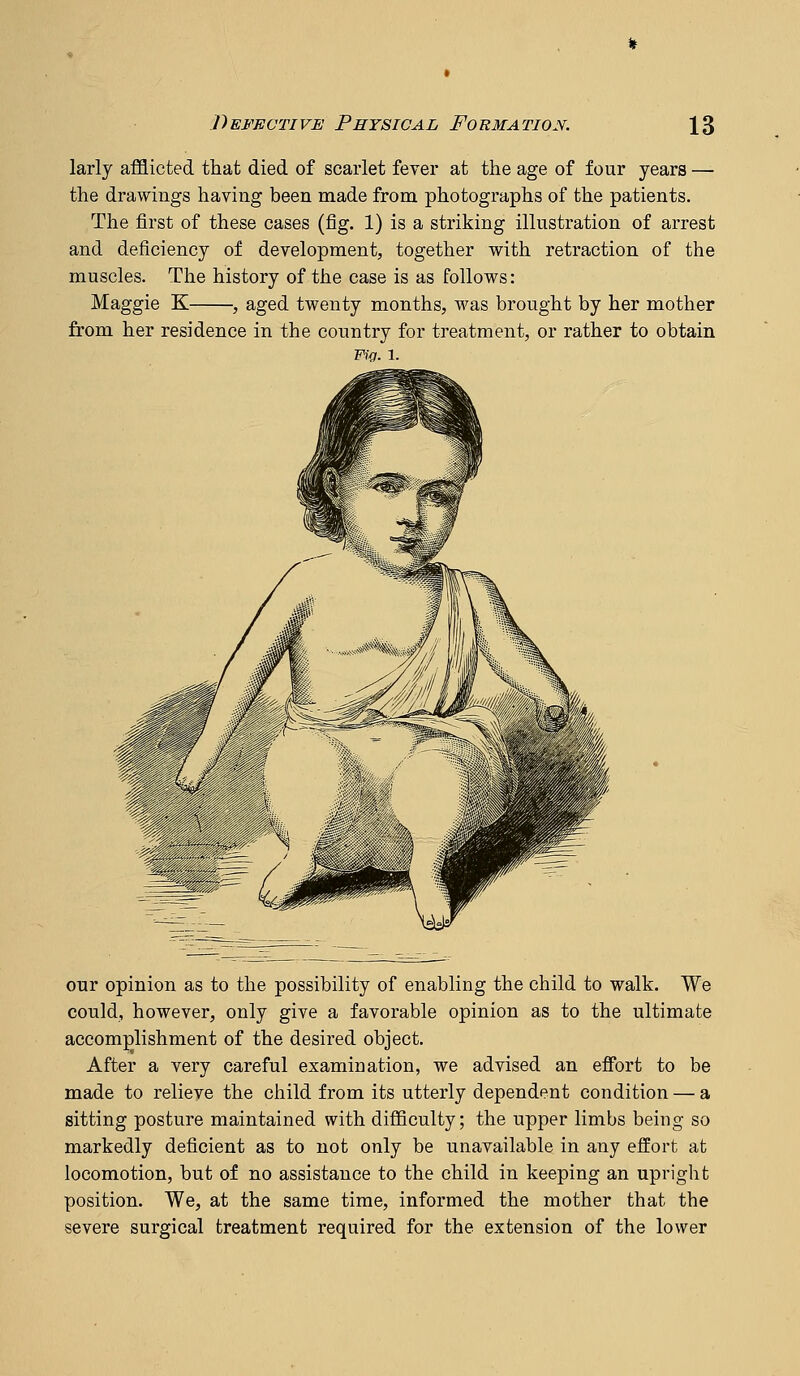 larly afflicted that died of scarlet fever at the age of four years — the drawings having been made from photographs of the patients. The first of these cases (fig. 1) is a striking illustration of arrest and deficiency of development, together with retraction of the muscles. The history of the case is as follows: Maggie K , aged twenty months, was brought by her mother from her residence in the country for treatment, or rather to obtain Fifj. 1. our opinion as to the possibility of enabling the child to walk. We could, however, only give a favorable opinion as to the ultimate accomplishment of the desired object. After a very careful examination, we advised an efibrt to be made to relieve the child from its utterly dependent condition — a sitting posture maintained with difficulty; the upper limbs being so markedly deficient as to not only be unavailable in any effort at locomotion, but of no assistance to the child in keeping an upright position. We, at the same time, informed the mother that the severe surgical treatment required for the extension of the lower