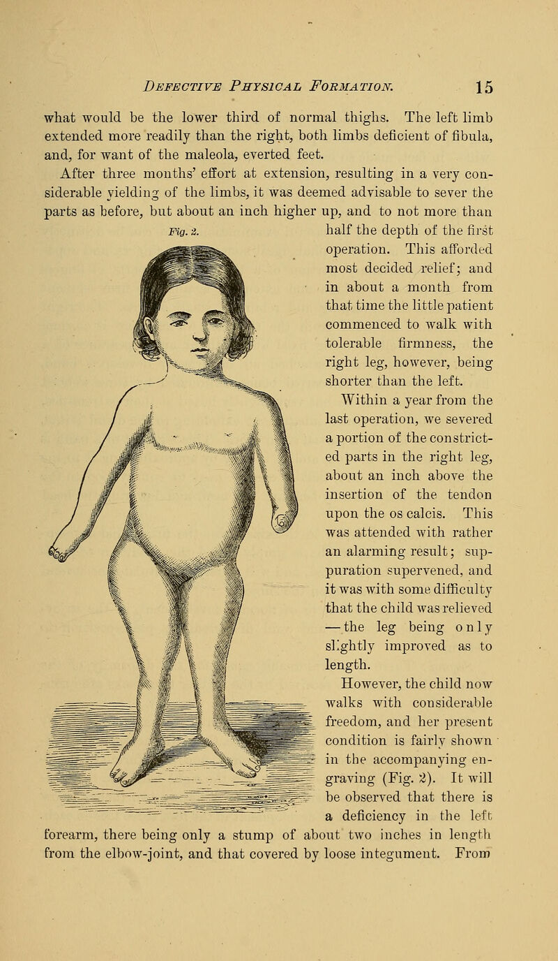 what would be the lower third of normal thighs. The left limb extended more readily than the right, both limbs deficient of fibula, and, for want of the maleola, everted feet. After three months' effort at extension, resulting in a very con- siderable yielding of the limbs, it was deemed advisable to sever the parts as before, but about an inch higher up, and to not more thau Fig. i. half the depth of the first operation. This afforded most decided relief; and in about a month from that time the little patient commenced to walk with tolerable firmness, the right leg, however, being shorter than the left. Within a year from the last operation, we severed a portion of the constrict- ed parts in the right leg, about an inch above the insertion of the tendon upon the os calcis. This was attended with rather an alarming result; sup- puration supervened, and it was with some difficulty that the child was relieved — the leg being only slightly improved as to length. However, the child now walks with considerable freedom, and her present condition is fairly shown in the accompanying en- graving (Fig. 2). It will be observed that there is a deficiency in the left forearm, there being only a stump of about two inches in length from the elbow-joint, and that covered by loose integument. From