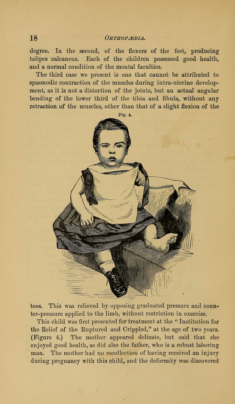 degree. In the second, of the flexors of the feet, producing talipes calcaneus. Each of the children possessed good health, and a normal condition of the mental faculties. The third case we present is one that cannot be attributed to spasmodic contraction of the muscles during intra-uterine develop- ment, as it is not a distortion of the joints, but an actual angular bending of the lower third of the tibia and fibula, without any retraction of the muscles, other than that of a slight flexion of the Fig. 4. toes. This was relieved by opposing graduated pressure and coun- ter-pressure applied to the limb, without restriction in exercise. This child was first presented for treatment at the  Institution for the Belief of the Ruptured and Crippled, at the age of two years. (Figure 4) The mother appeared delicate, but said that she enjoyed good health, as did also the father, who is a robust laboring man. The mother had no recollection of having received an injury during pregnancy with this child, and the deformity was discovered