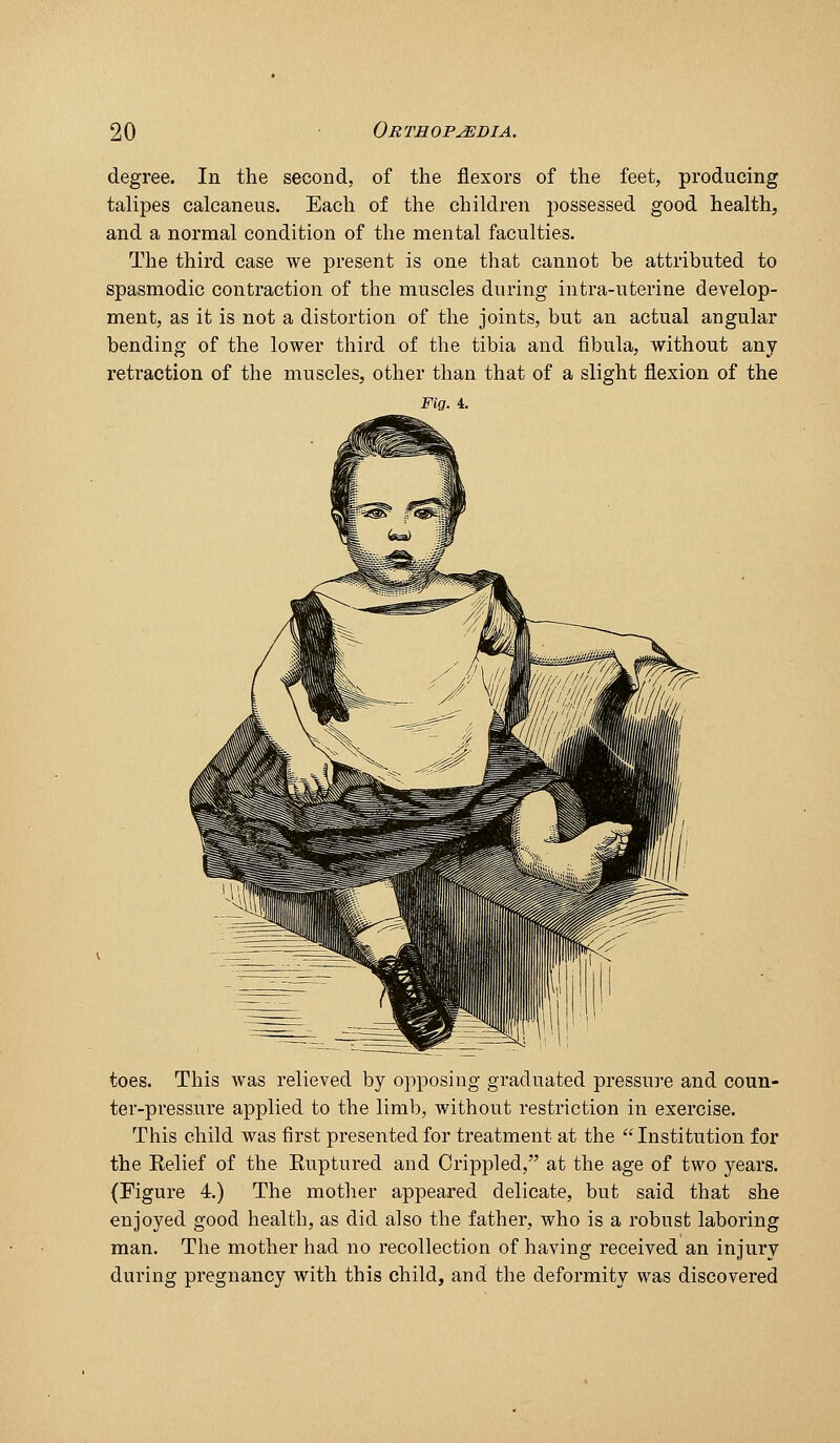 degree. In the second, of the flexors of the feet, producing talipes calcaneus. Each of the children possessed good health, and a normal condition of the mental faculties. The third case we present is one that cannot be attributed to spasmodic contraction of the muscles during intra-uterine develop- ment, as it is not a distortion of the joints, but an actual angular bending of the lower third of the tibia and fibula, without any retraction of the muscles, other than that of a slight flexion of the Fig. 4. toes. This was relieved by opposing graduated pressure and coun- ter-pressure applied to the limb, without restriction in exercise. This child was first presented for treatment at the Institution for the Eelief of the Euptured and Crippled, at the age of two years. (Figure 4.) The mother appeared delicate, but said that she enjoyed good health, as did also the father, who is a robust laboring man. The mother had no recollection of having received an injury during pregnancy with this child, and the deformity was discovered