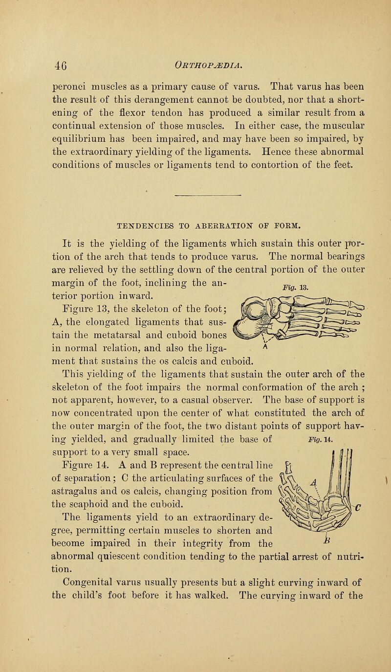 peronei muscles as a primary cause of varus. That varus has been the result of this derangement cannot be doubted, nor that a short- ening of the flexor tendon has produced a similar result from a continual extension of those muscles. In either case, the muscular equilibrium has been impaired, and may have been so impaired, by the extraordinary yielding of the ligaments. Hence these abnormal conditions of muscles or ligaments tend to contortion of the feet. Fig. 13. '^^ TENDENCIES TO ABEKRATION OF FORM. It is the yielding of the ligaments which sustain this outer p*or- tion of the arch that tends to produce varus. The normal bearings are relieved by the settling down of the central portion of the outer margin of the foot, inclining the an- terior portion inward. Eigure 13, the skeleton of the foot; A, the elongated ligaments that sus- tain the metatarsal and cuboid bones in normal relation, and also the liga- ment that sustains the os calcis and cuboid. This yielding of the ligaments that sustain the outer arch of the skeleton of the foot impairs the normal conformation of the arch ; not apparent, however, to a casual observer. The base of support is now concentrated upon the center of what constituted the arch of the outer margin of the foot, the two distant points of support hav- ing yielded, and gradually limited the base of mg.u. support to a very small space. Figure 14. A and B represent the central line h of separation; C the articulating surfaces of the astragalus and os calcis, changing position from the scaphoid and the cuboid. The. ligaments yield to an extraordinary de- gree, permitting certain muscles to shorten and become impaired in their integrity from the abnormal quiescent condition tending to the partial arrest of nutri- tion. Congenital varus usually presents but a slight curving inward of the child's foot before it has walked. The curving inward of the B