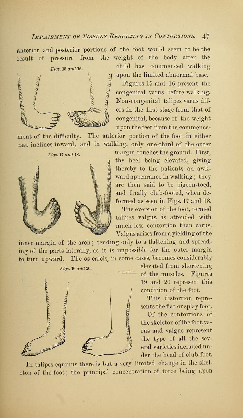 Wigs. 15 and 16. anterior and posterior portions of the foot would seem to be the result of pressure from the weight of the body after the child has commenced walking upon the limited abnormal base. Figures 15 and 16 present the congenital varus before walking. Non-congenital talipes varus dif- ers in the first stage from that of congenital, because of the weight upon the feet from the commence- ment uf the difficulty. The anterior portion of the foot in either case inclines inward, and in walking, only one-third of the outer Figs. 17 ana 18. margin touches the ground. First, the heel being elevated, giving thereby to the patients an awk- ward appearance in walking; they are then said to be pigeon-toed, and finallv club-footed, when de- formed as seen in Figs. 17 and 18. The eversion of the foot, termed talipes valgus, is attended with much less contortion than varus. Valgus arises from a yielding of the inner margin of the arch; tending only to a flattening and spread- ing of the parts laterally, as it is impossible for the outer margin to turn upward. The os calcis, in some cases, becomes considerably elevated from shortening of the muscles. Figures 19 and 20 represent this condition of the foot. This distortion repre- sents the flat or splay foot. Of the contortions of the skeleton of the foot,va- rus and valgus represent the type of all the sev- eral varieties included un- der the head of chib-foot. In talipes equinus there is but a very limited change in the skel- eton of tbe foot; the principal concentration of force being upon Figs. 19 and 20.